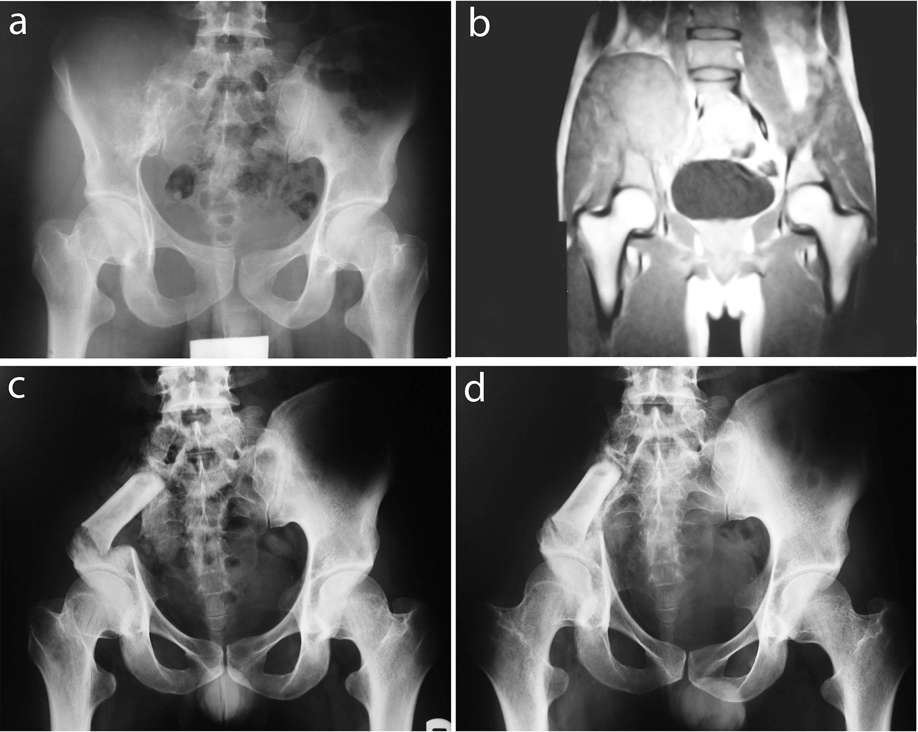 Fig. 4 
            a) Anteroposterior radiograph of the hip showing pre-chemotherapy Ewing’s sarcoma of the ilium in a 23-year-old male. b) T1-weighted MRI of the hip showing the tumour extension close to the sacroiliac joint (Zone I3 resection). c) Anteroposterior radiograph of the hip six months after surgical resection and reconstruction with tibial strut graft. d) Anteroposterior radiograph of the hip three years after surgical resection and reconstruction, showing the complete incorporation of the graft into the host bone.
          