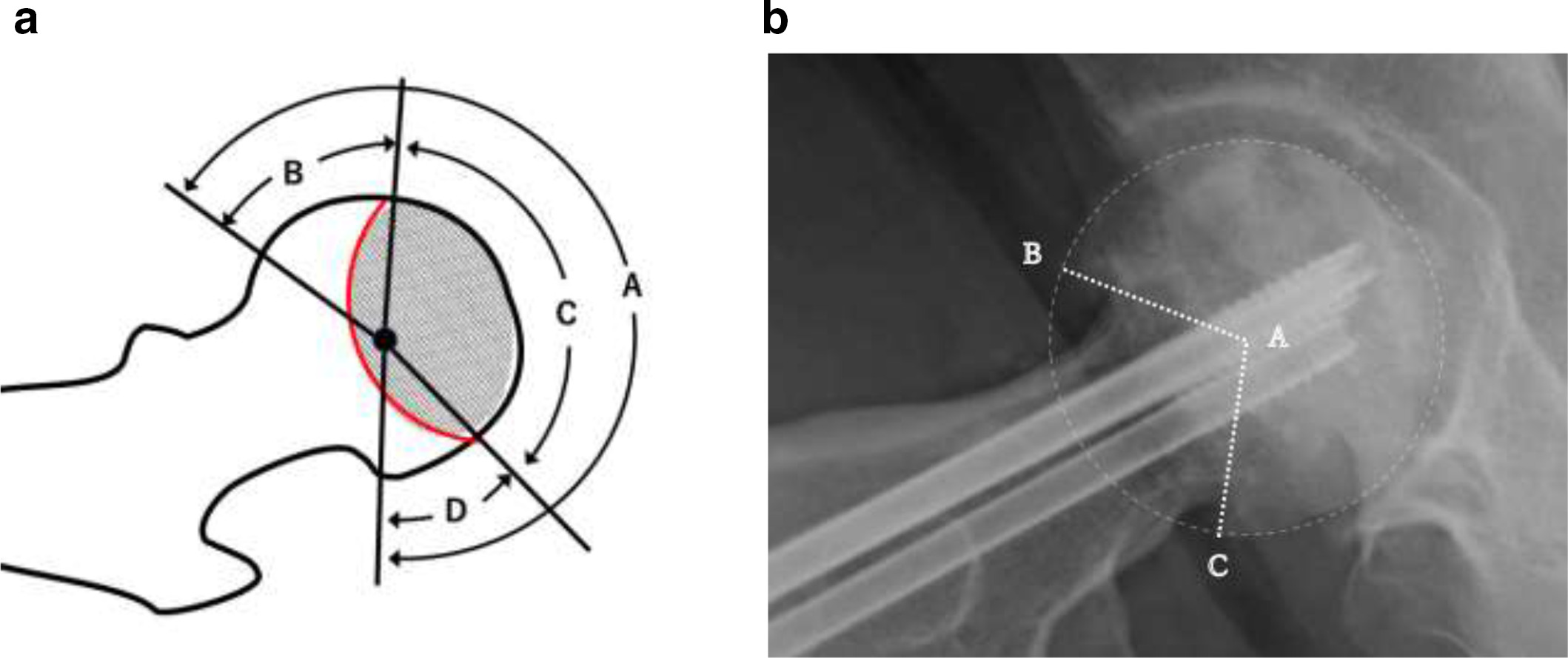 Fig. 1 
            a) Diagram showing the method for measuring the extent of the viable and necrotic areas of the femoral head on the lateral radiograph (Sugioka view). The ratio of the anterior viable area was calculated by dividing angle B (anterior reference point of the articular surface) by angle A (centre of the femoral head). The ratio of the posterior viable area was calculated by dividing angle D (posterior reference point of the articular surface) by angle A. The ratio of the necrotic area was calculated by dividing angle C (necrotic area from anterior to posterior point of the articular surface) by angle A. b) Evaluation of the articular surface in a case where the margin was unclear due to depression of the fracture. The distal end of the femoral head was used as the reference point for the articular surface.
          