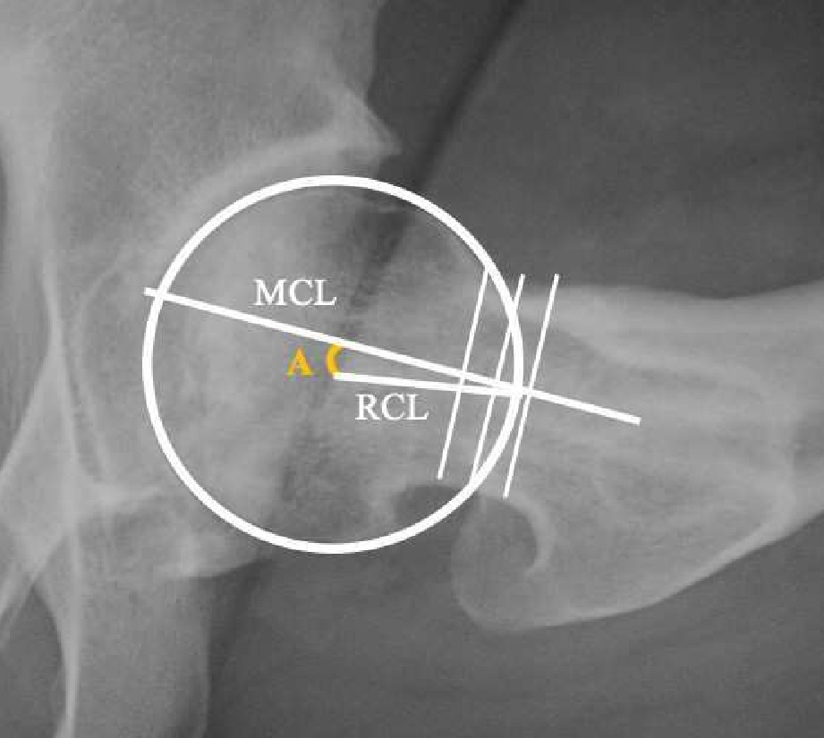 Fig. 2 
            The posterior tilt angle (angle A) was measured with Palm’s method on the lateral radiograph (Sugioka view). Angle A was measured between two lines, the mid-collum line (MCL) and the radius collum line (RCL). The middle of the collum (femoral neck) is determined by drawing three perpendicular lines across the narrowest part of the collum with 5 mm between each line. The RCL is drawn from the middle of the femoral head to the intersection of the MCL and the caput circle.
          