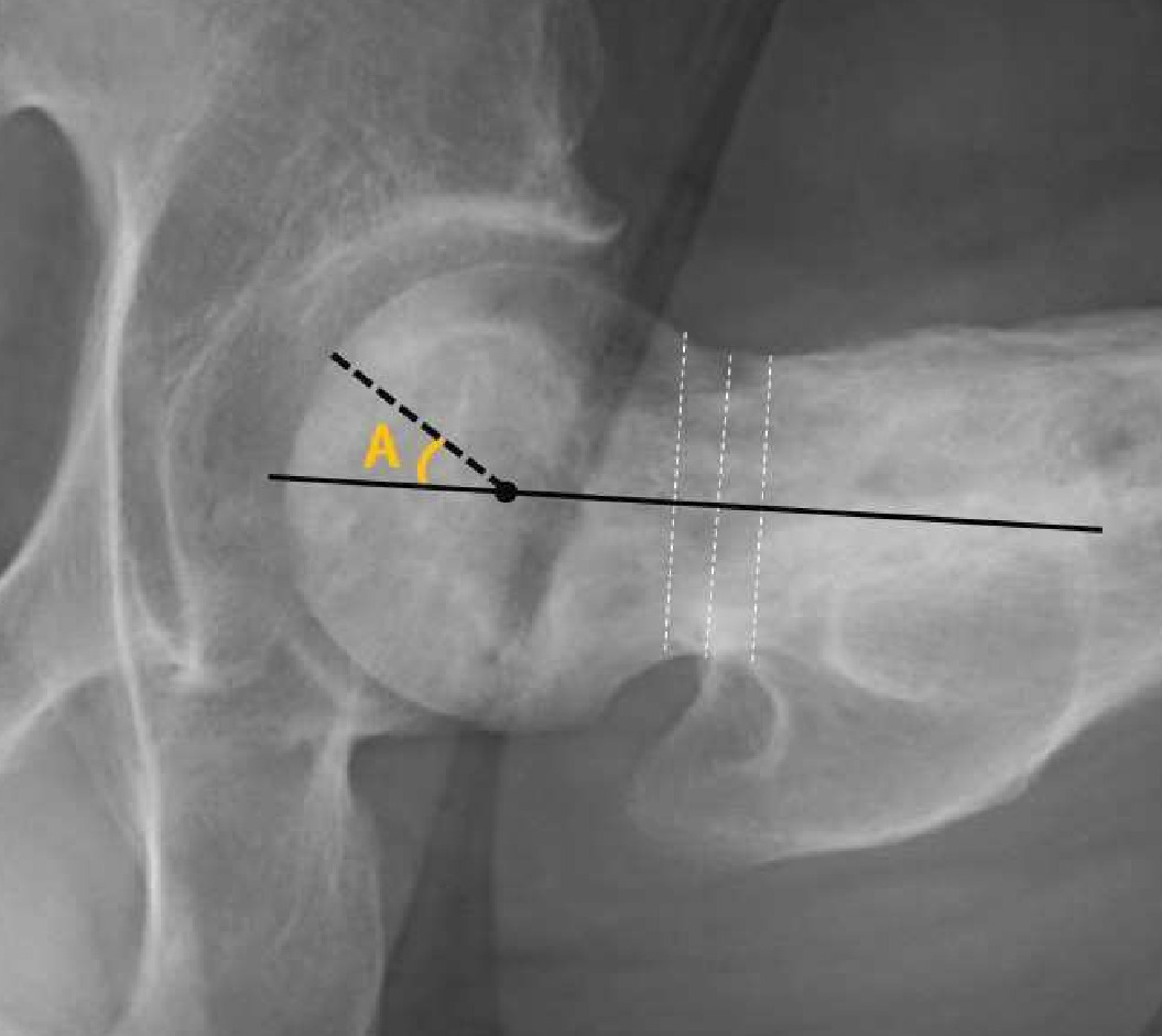 Fig. 3 
            Measurement of the anterior necrotic angle (angle A). Angle A was measured between two lines, the radius collum line (RCL) and a line passing from the centre of the femoral head to the anterior boundary of the necrotic area. The solid line indicates the RCL, and the dotted line indicates a line passing from the centre of the femoral head to the anterior boundary of the necrotic area.
          