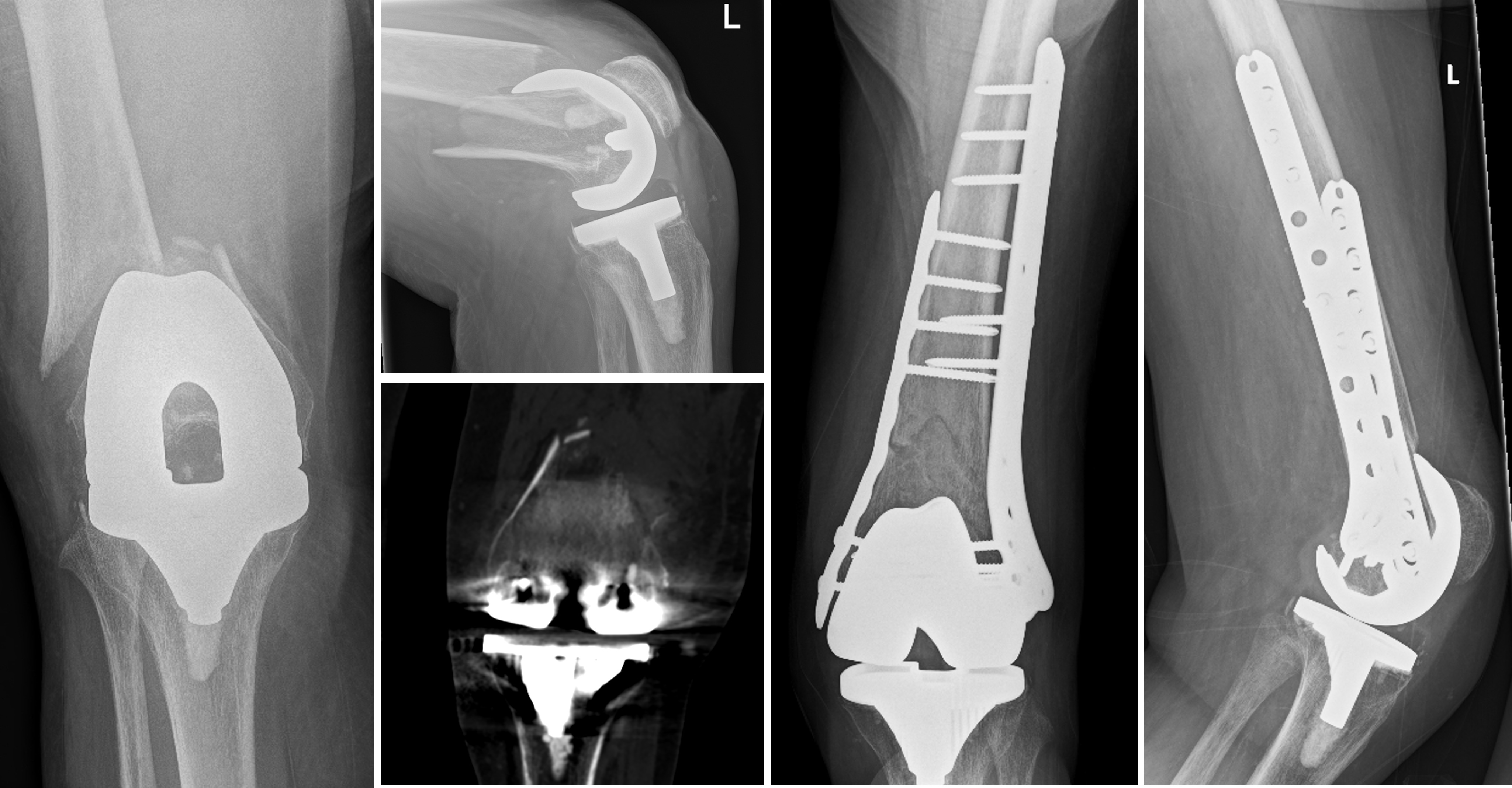 Fig. 1 
          Anteroposterior and lateral views of a periprosthetic distal femur fracture in a 73-year-old female around a standard total knee arthroplasty treated with double plating. The coronal plane CT image confirms no additional sagittal plane split in the distal fragment, and sufficient bone stock to enable fixation. Post fixation radiographs are shown here at seven months.
        