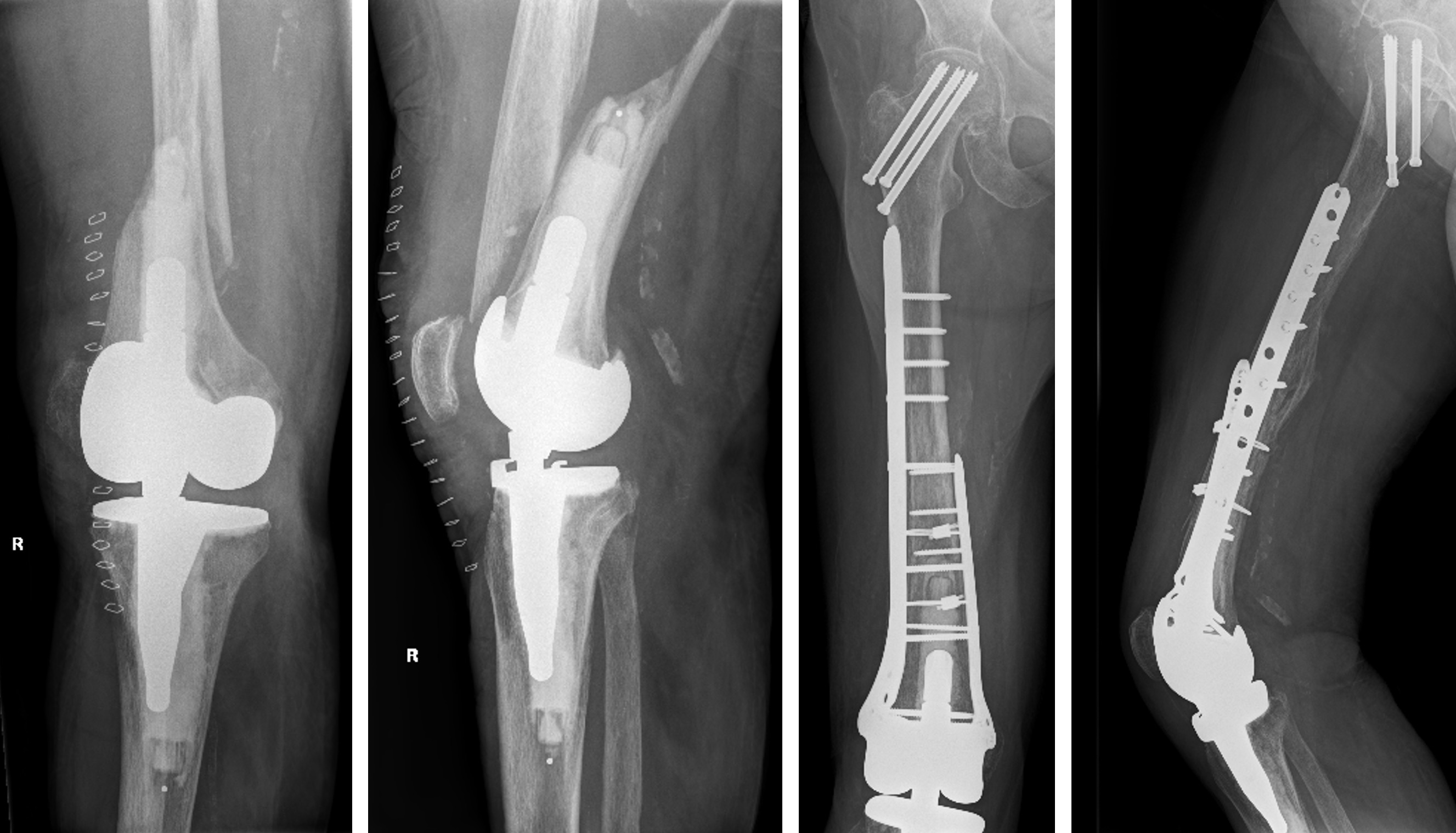 Fig. 2 
          Double plating of a periprosthetic distal femur fracture of a 78-year-old female around a hinged total knee arthroplasty. The anteroposterior and lateral radiographs demonstrate the fracture preoperatively and at five months postoperatively.
        
