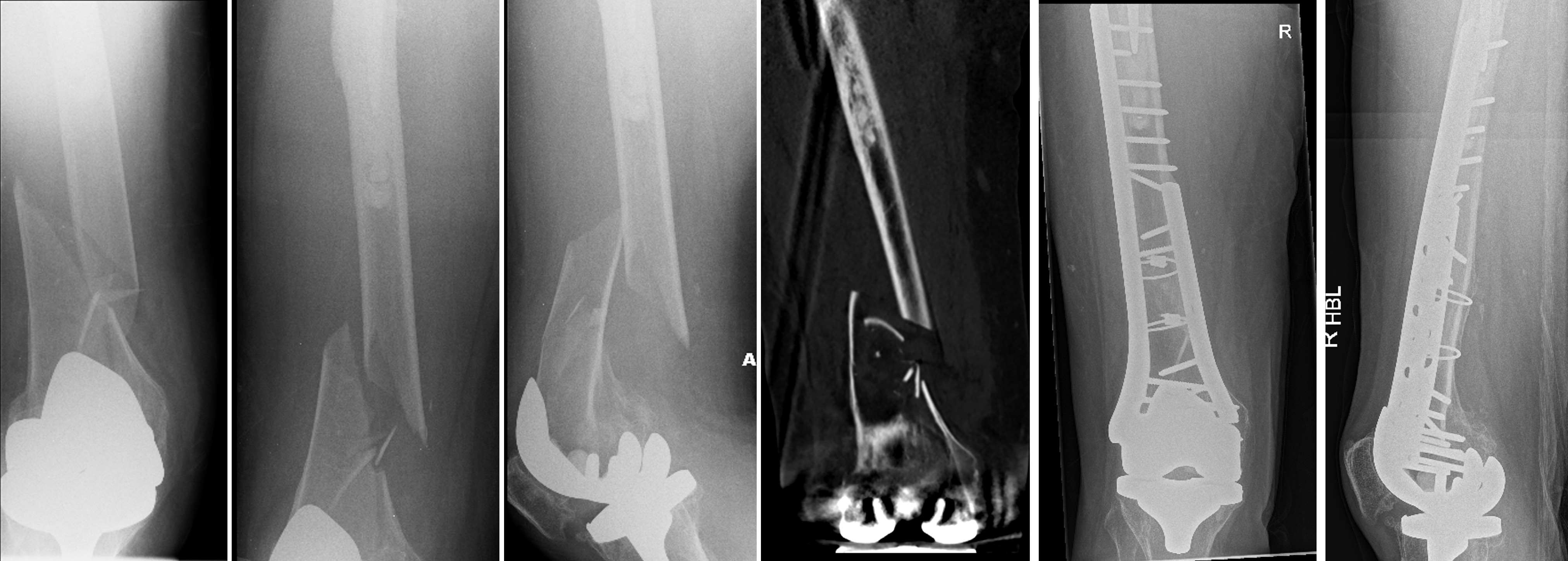 Fig. 3 
          Double plating for treatment of an interprosthetic distal femur fracture of an 88-year-old female with anatomical reduction and satisfactory healing. The anteroposterior and lateral radiographs and coronal CT demonstrate metaphyseal comminution preoperatively, but no sagittal split. Postoperative radiographs (taken at 47 months) demonstrate union.
        