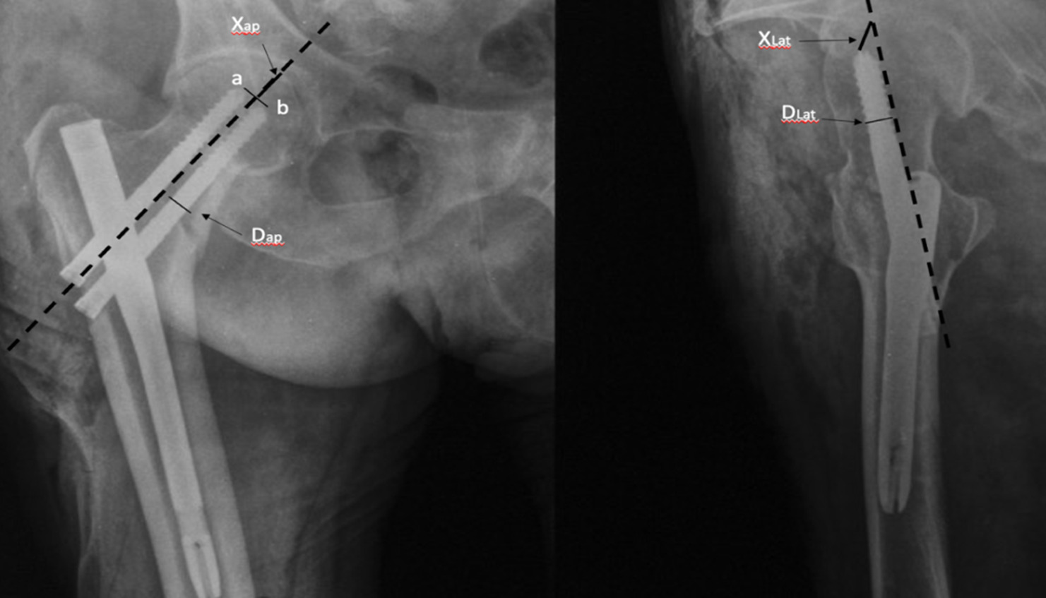 Fig. 1 
            Tip-apex distance in anterior-posterior and lateral views of intertrochanteric femur nailing. “Xap” was measured as the distance from the apex of the femoral head to a midpoint between the tips of the two screws, “Xlat” was the distance between the tips in lateral view and the femoral head, and “Dap” and “Dlat” were the diameter of the screws, respectively, in the two views.
          