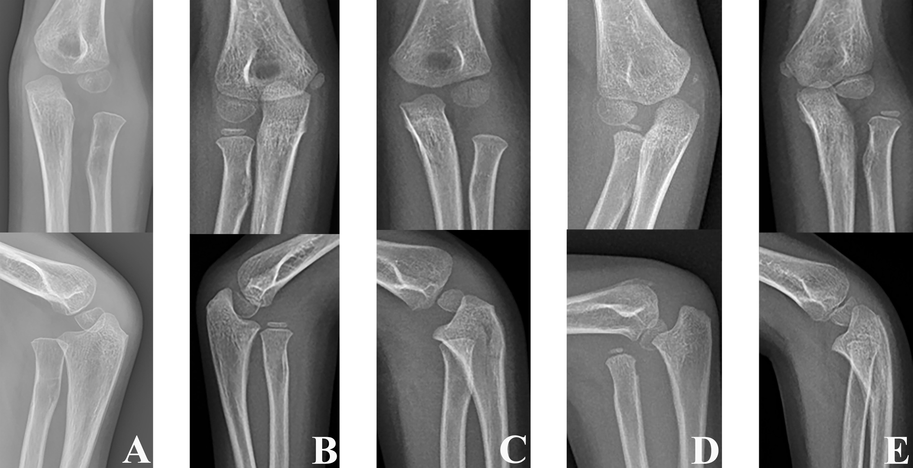 Fig. 1 
            Direction of radial head dislocation according to anteroposterior and lateral radiographs: a) anterolateral, b) anterior, c) lateral, d) anteromedial, and e) posterolateral.
          