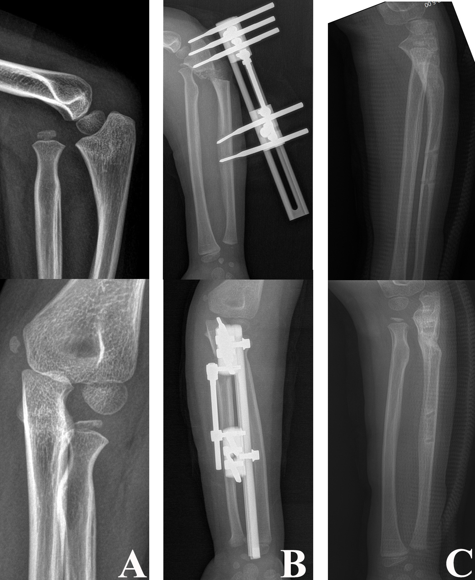 Fig. 10 
          a) Anteroposterior and lateral radiographs of a six-year-old female with a chronic Monteggia fracture with a ten-month interval between injury and surgery. b) Anteroposterior and lateral radiographs after open reduction and fixation of the ulna osteotomy with monolateral external fixator. c) Anteroposterior and lateral radiographs performed at the six-month follow-up showing the reduced radial head.
        