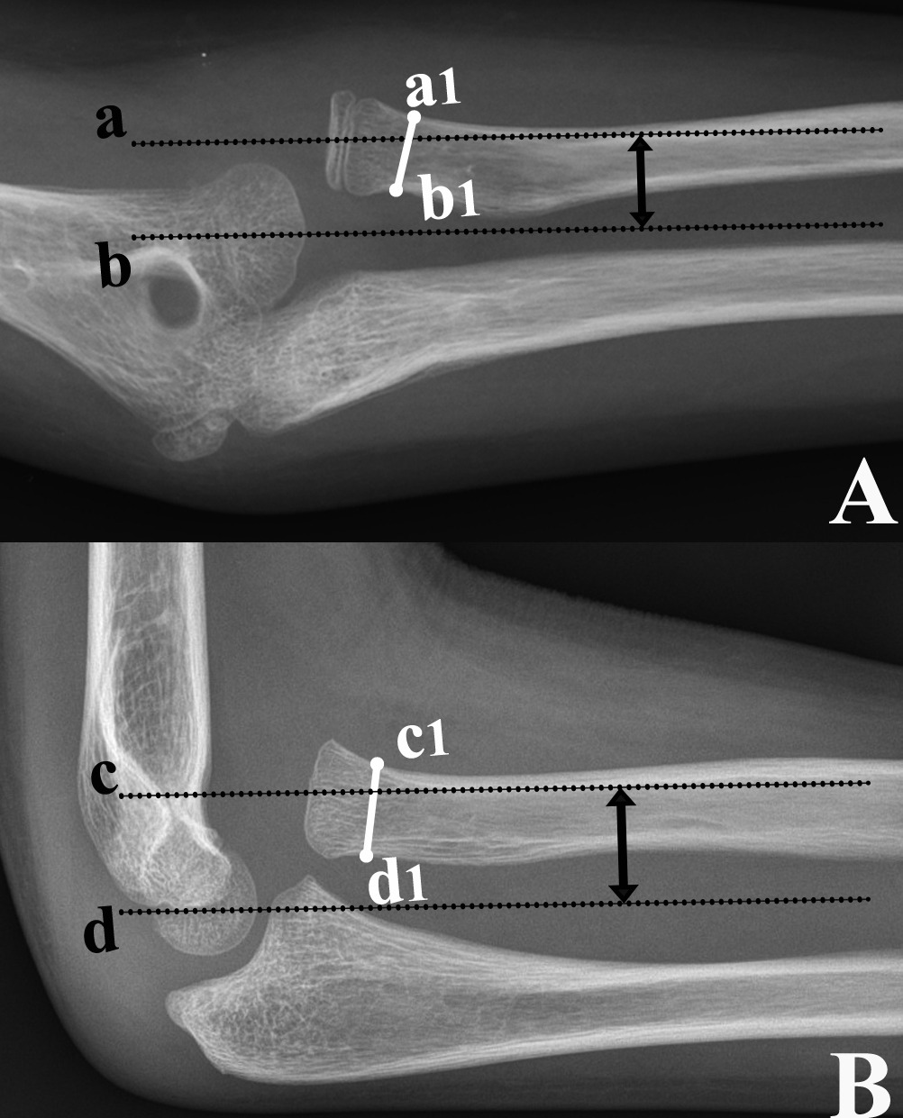 Fig. 2 
            Radial head elevation, measured on anteroposterior (A) and lateral (B) radiographs, is expressed as the ratio of the distance between the lines passing through the centre of the proximal radial metaphysis (a and c) and the centre of the humeral capitellum (b and d) to that of the narrowest width of the radial neck (a1 to b1 and c1 to d1).
          