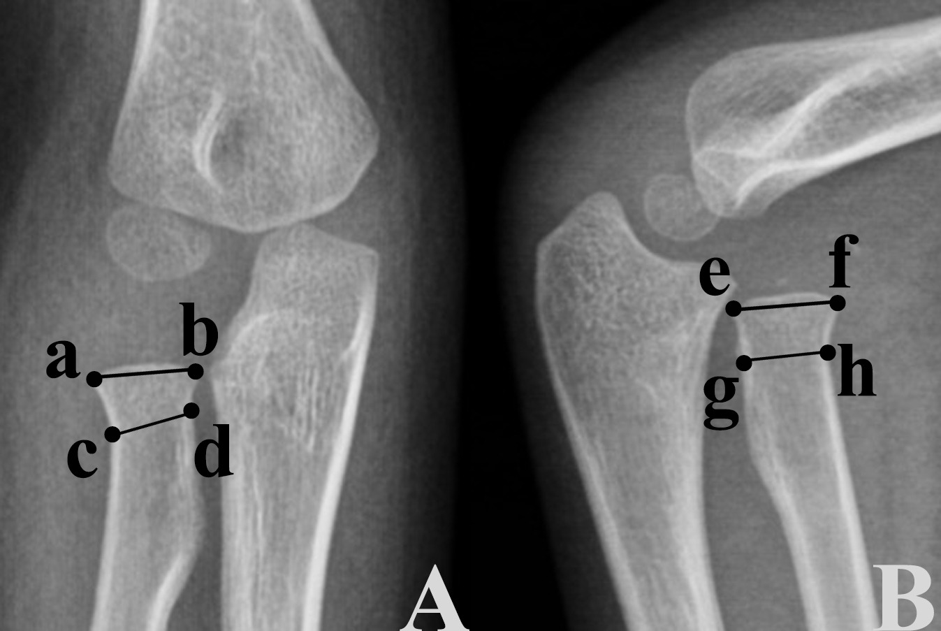 Fig. 3 
            The width of the proximal radial metaphysis measured on anteroposterior (A) and lateral (B) radiographs, is the ratio of the width (a to b, and e to f) of the proximal radial metaphysis to the width (c to d, and g to h) of the narrowest part of the radial neck.
          
