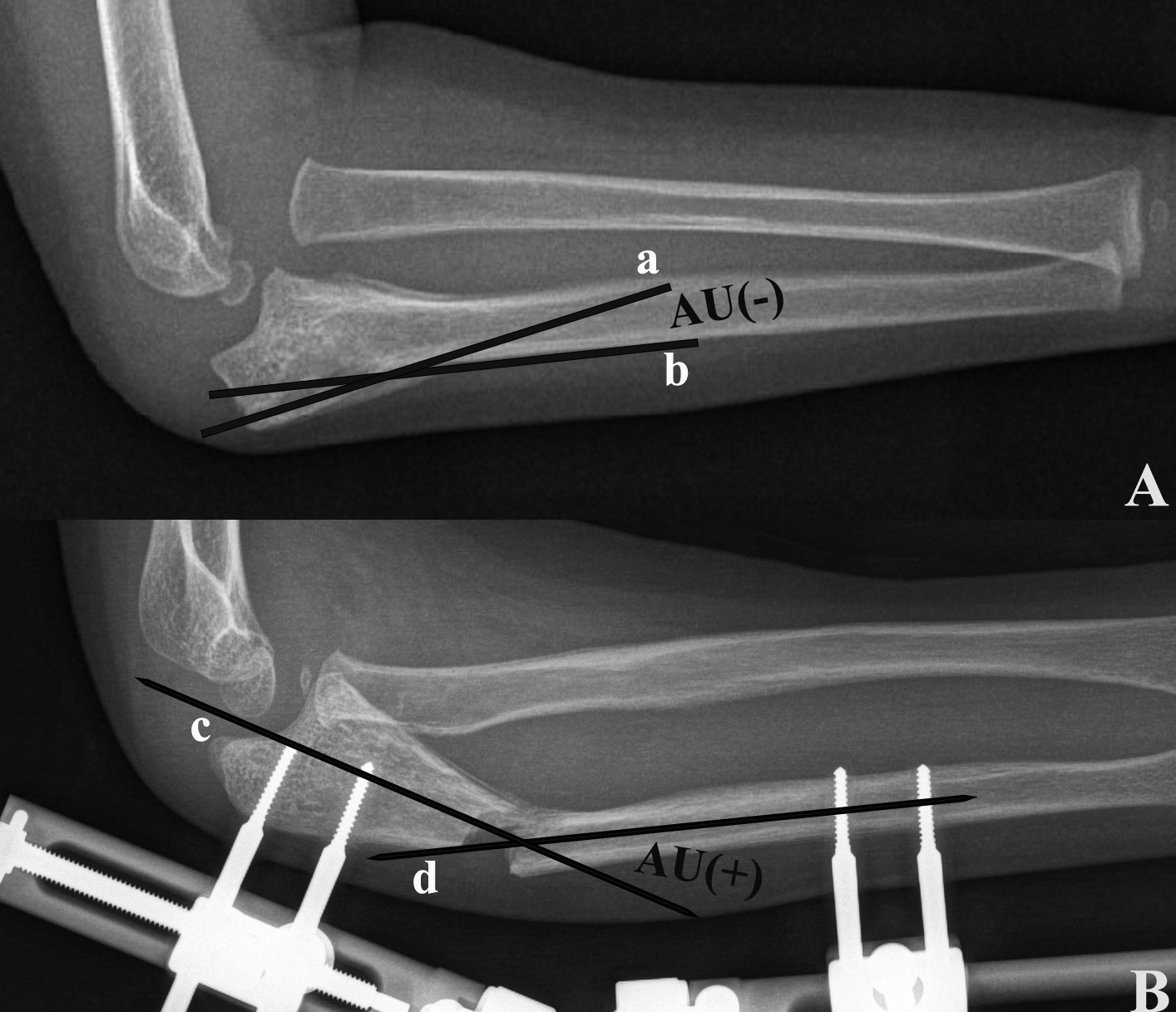 Fig. 4 
            Preoperative (A) and postoperative (B) angulation of the ulnar (AU) measured on lateral radiographs. AU is the angle between the axis of the proximal (lines a and c) and distal portions of the ulna (lines b and d). It is expressed as zero when the two axes are parallel, negative when the apex of the intersecting axes is inferior (forming an inverted V-shape), and positive when superior (forming a V-shape).
          