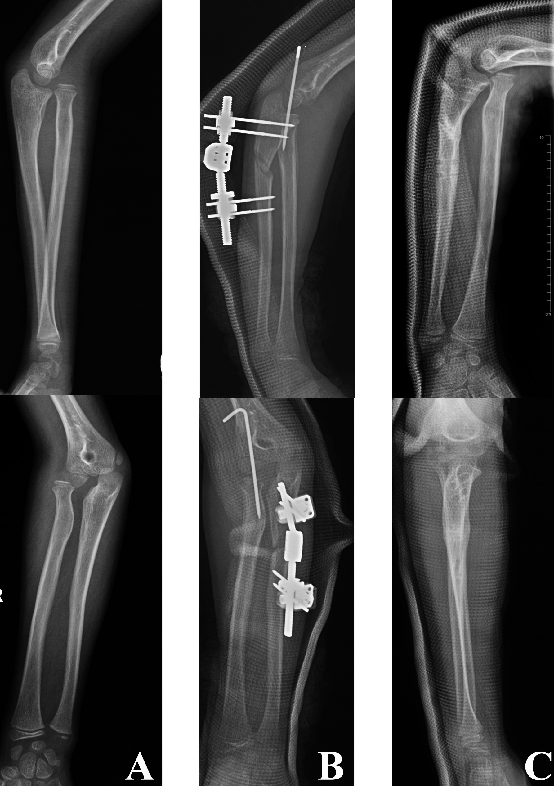 Fig. 6 
          a) Anteroposterior and lateral radiographs of an eight-year-old female with a chronic Monteggia fracture with a three-year interval between injury and surgery. b) Anteroposterior and lateral radiographs after open reduction, external fixation of the ulna, radiocapitellar joint fixation with Kirschner wire and postoperative cast immobilization. c) Anteroposterior and lateral radiographs performed at the nine-month follow-up showing redislocation of the radial head.
        