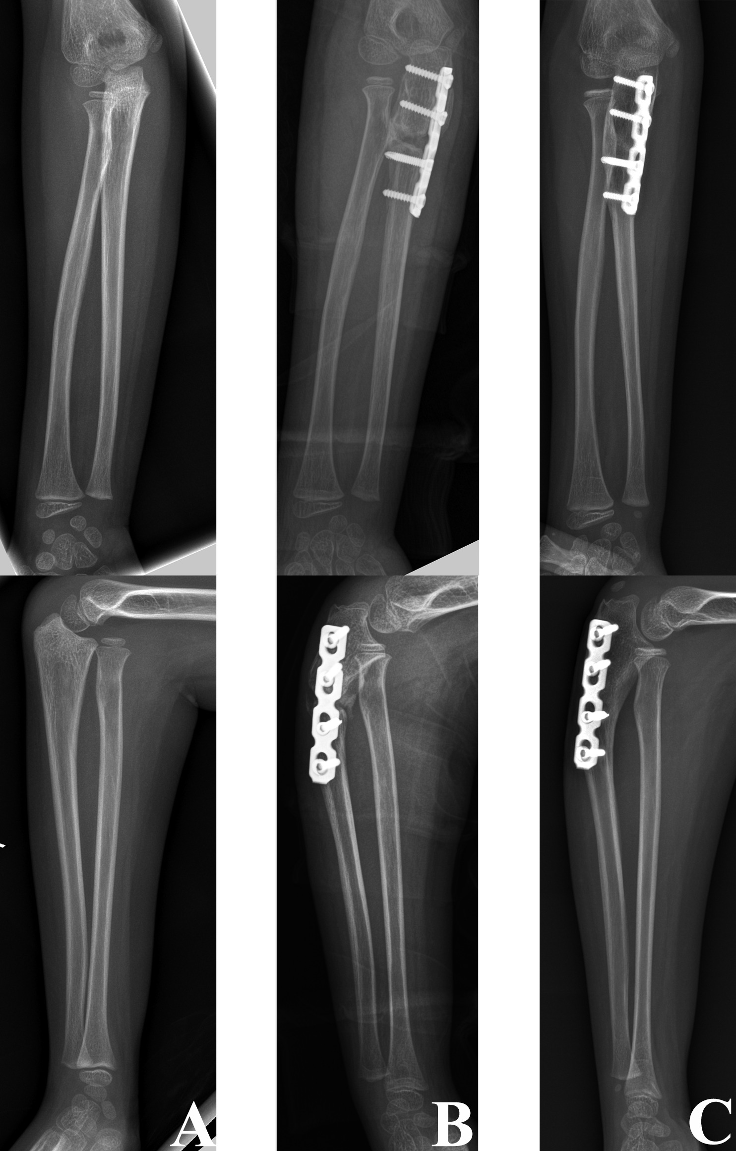 Fig. 7 
          a) Anteroposterior and lateral radiographs of a six-year-old female with a chronic Monteggia fracture with an interval of 1.5 months between injury and surgery. b) Anteroposterior and lateral radiographs after open reduction and fixation of the ulna osteotomy with plate and screws. c) Anteroposterior and lateral radiographs performed at 17-month follow-up showing the reduced radial head.
        