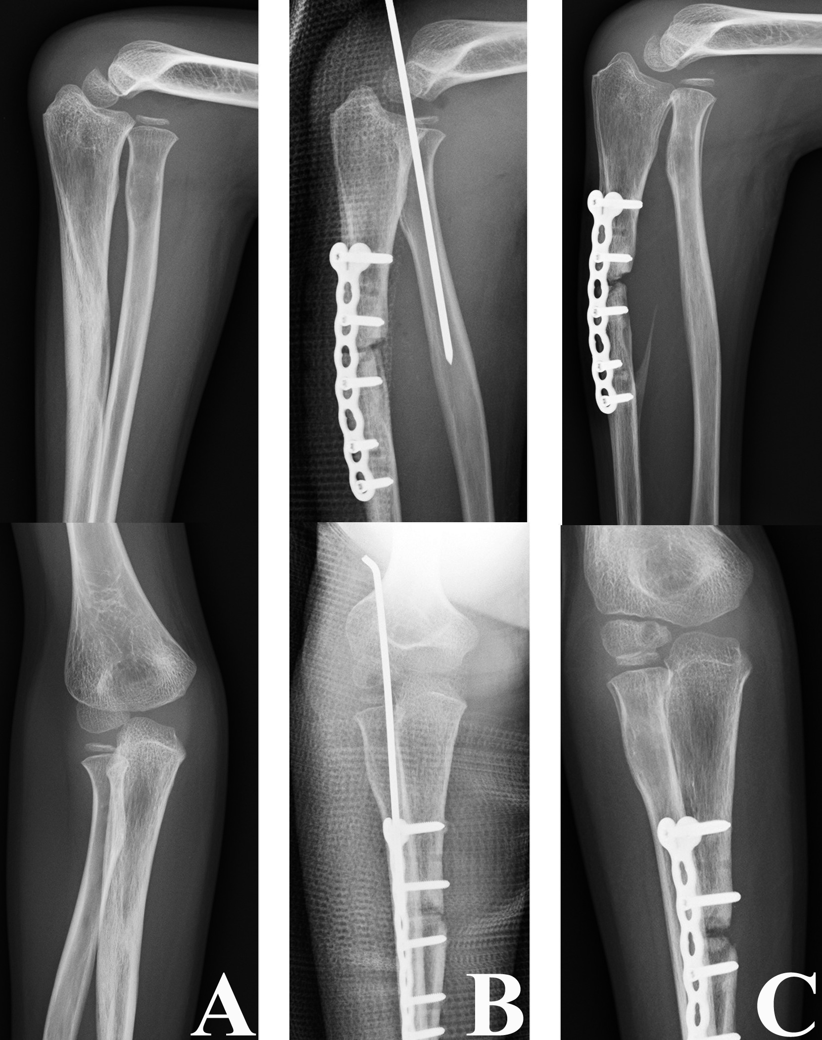 Fig. 8 
          a) Anteroposterior and lateral radiographs of an eight-year-old male with a chronic Monteggia fracture with a six-month interval between injury and surgery. b) Anteroposterior and lateral radiographs after open reduction, fixation of the ulna osteotomy with plate and screws, radiocapitellar joint fixation with Kirschner wire and postoperative cast immobilization. c) Anteroposterior and lateral radiographs performed at the three-month follow-up showing redislocation of the radial head.
        