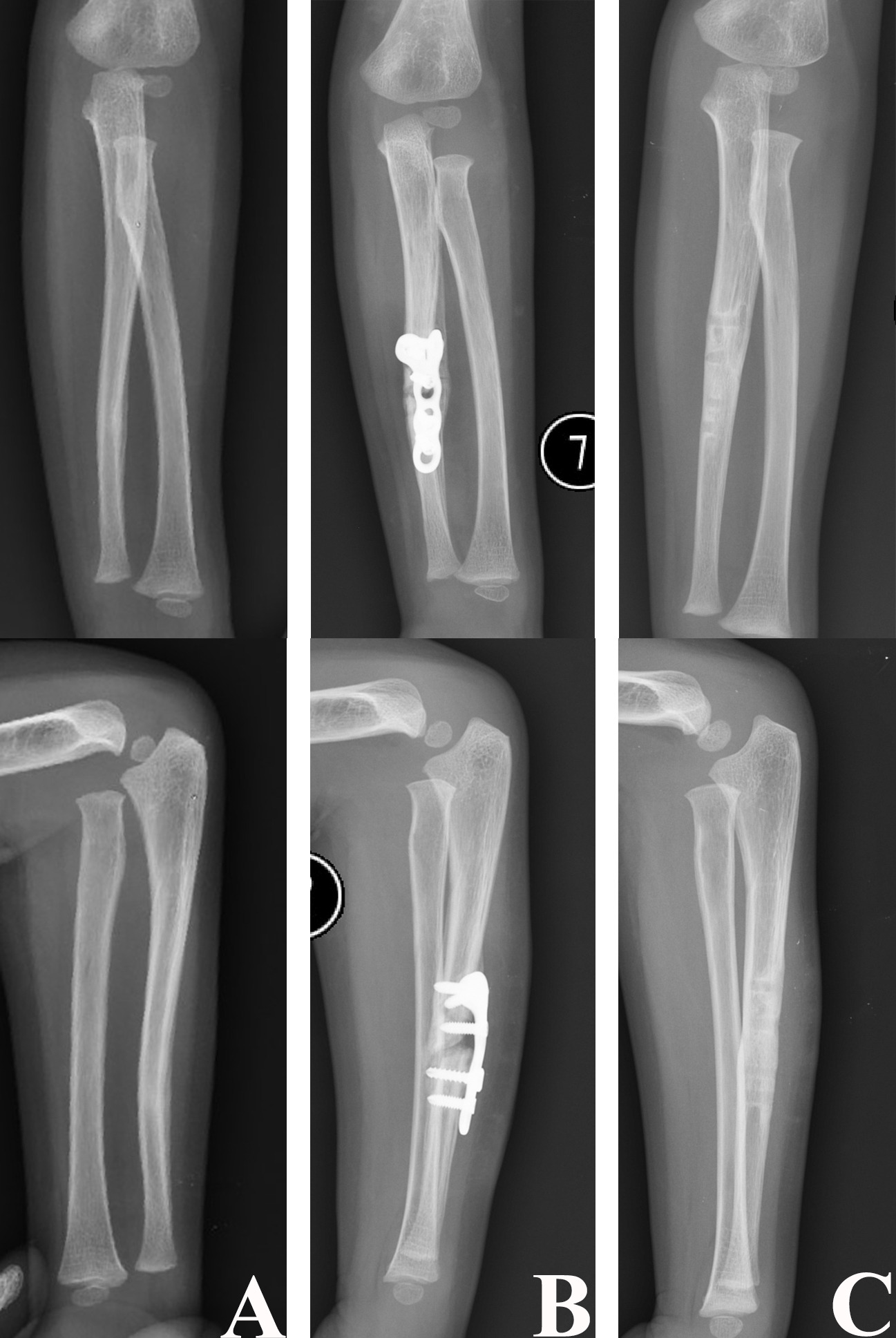 Fig. 9 
          a) Anteroposterior and lateral radiographs of a two-year-old female with a chronic Monteggia fracture with a one-month interval between injury and surgery. b) Anteroposterior and lateral radiographs after open reduction and fixation of the ulna osteotomy with plate and screws. c) Anteroposterior and lateral radiographs performed at the nine-month follow-up showing the reduced radial head.
        