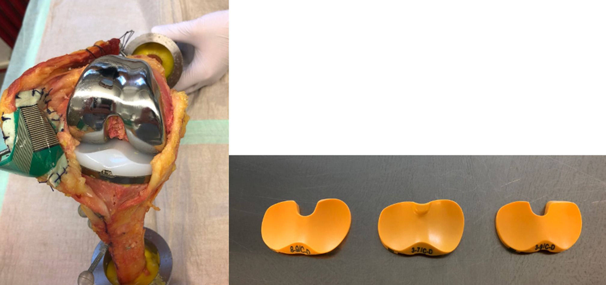 Fig. 2 
            The left photograph shows the standard cruciate-retaining (CR) total knee arthroplasty implanted after mechanical alignment. The inserts used are shown in the photograph on the right: the medial congruent insert on the left with a deepened medial plateau and a flattened lateral plateau, the ultra-congruent insert in the centre with medial and lateral conformity, and the standard CR insert on the right.
          