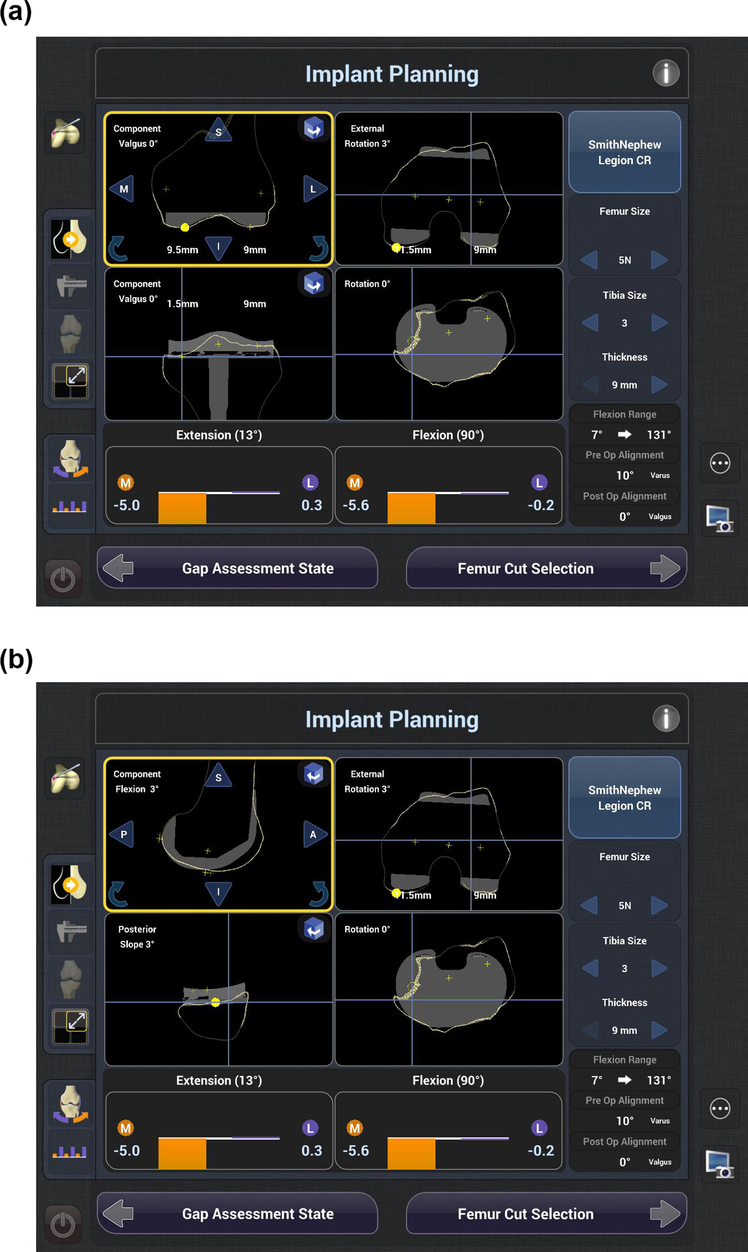 Fig. 1 
            a) The surgical plan based on mechanical alignment, with the coronal and axial views of the planned femoral and tibial component positioning. b) The surgical plan based on mechanical alignment, with the sagittal and axial views of the planned femoral and tibial component positioning.
          