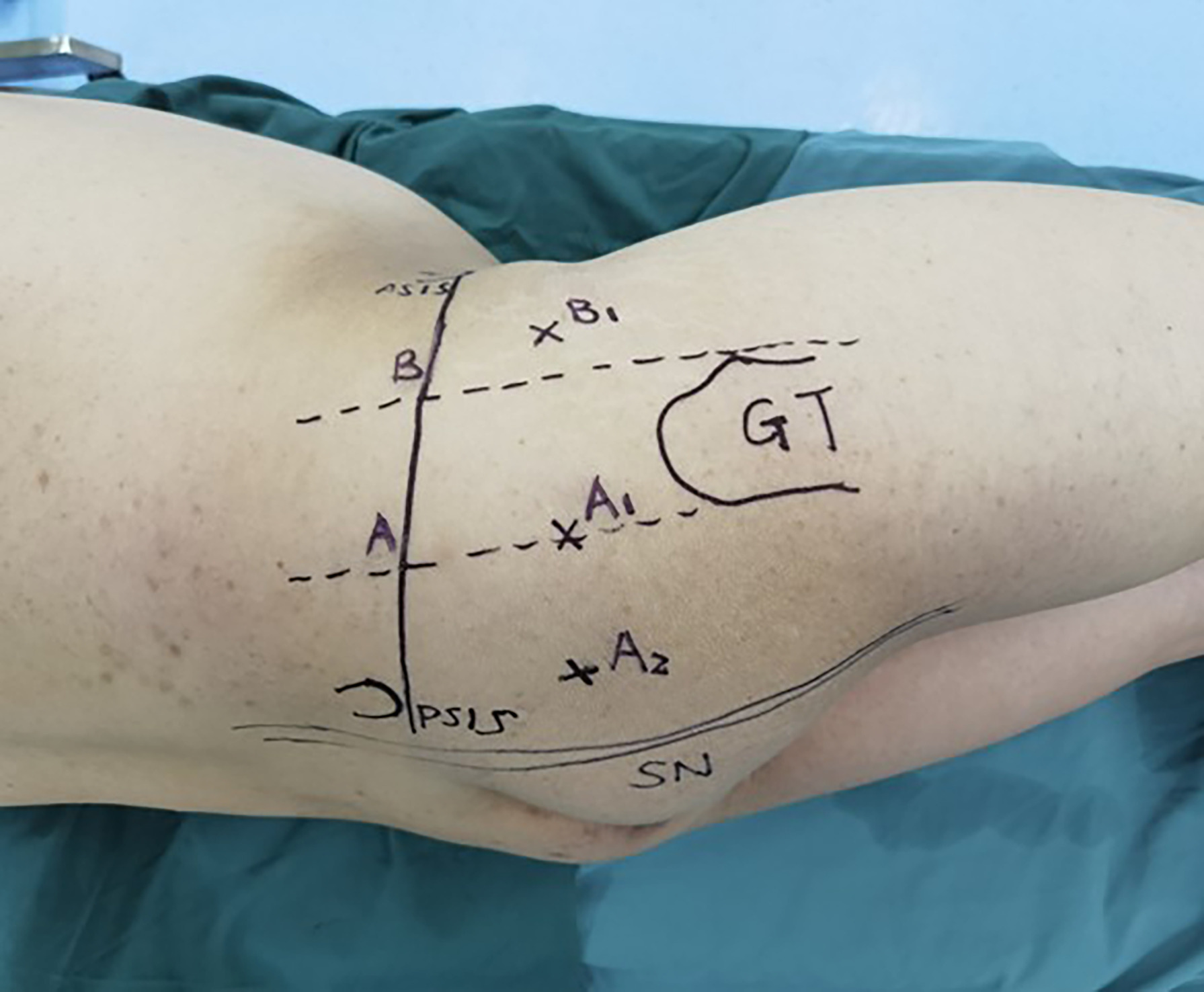 Fig. 1 
            Photograph showing confirmation of points A1 and A2 for skin markers. ASIS, anterior superior iliac spine; GT, greater trochanter; PSIS, posterior superior iliac spine; SN, sciatic nerve.
          