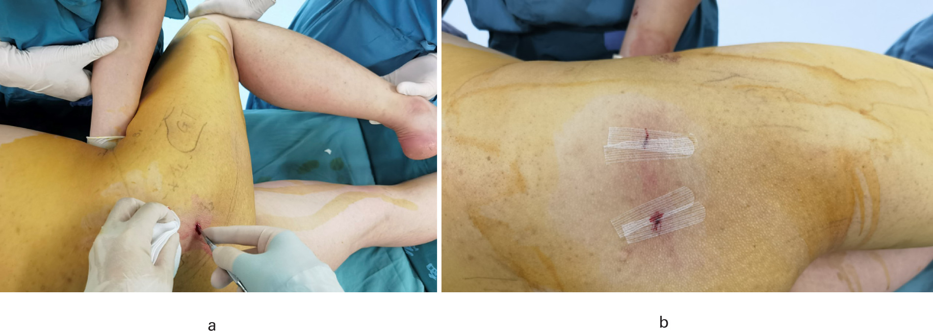 Fig. 2 
            a) Contracture release surgery was performed with a special scalpel though the preoperative designed incision (first at point A2, then at point A1 if required). b) The incision was wiped dry and sealed by a beauty pull tape.
          