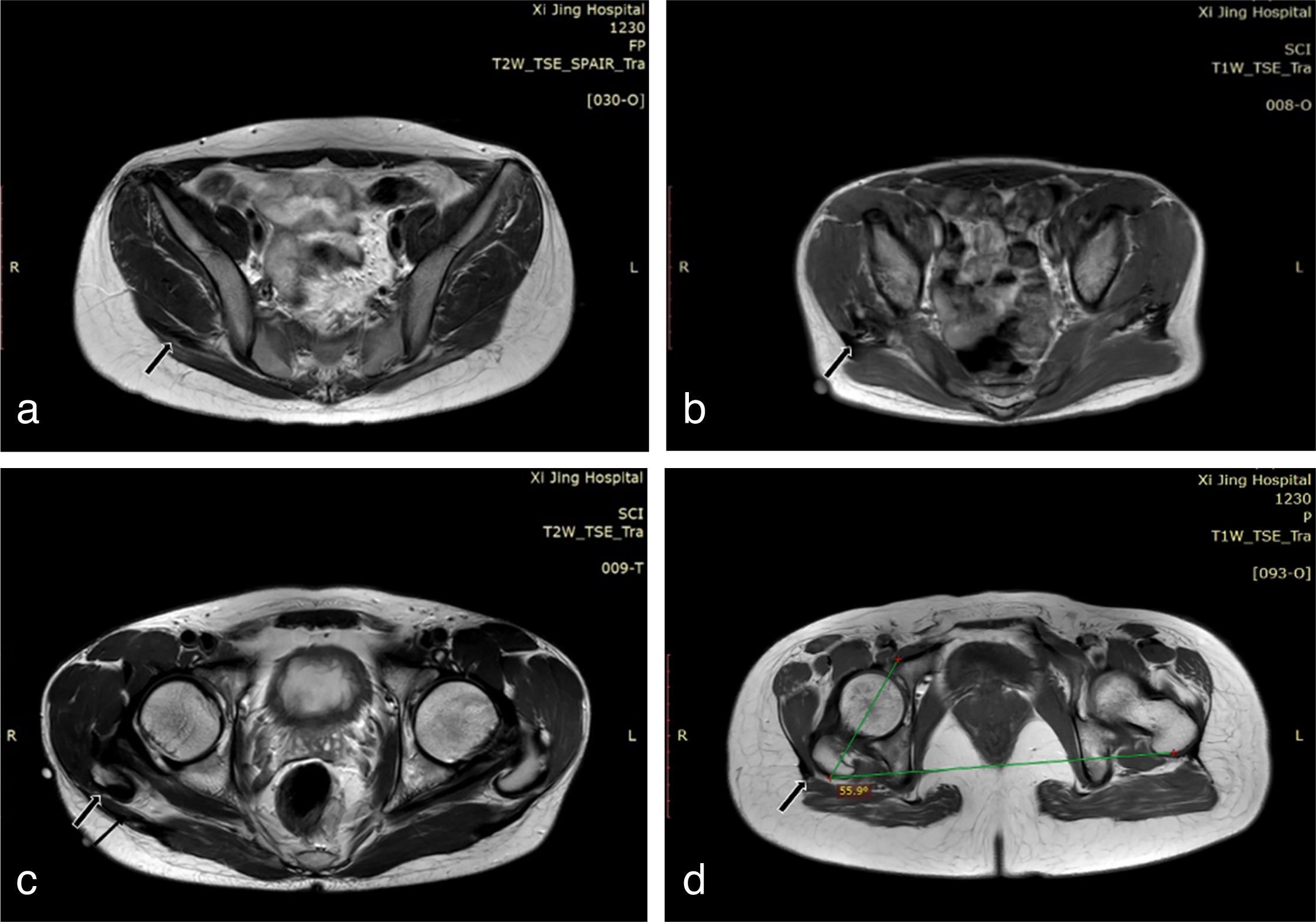 Fig. 3 
            Contracture bands mostly displayed three types of MR morphology: a) feather shapes, b) strip shapes, and c) mixed shapes. d) In some cases, the thicker fibrotic contracture caused medial retraction of the affected muscles, resulting in the external rotation of proximal femur. Arrow indicates contracture bands.
          