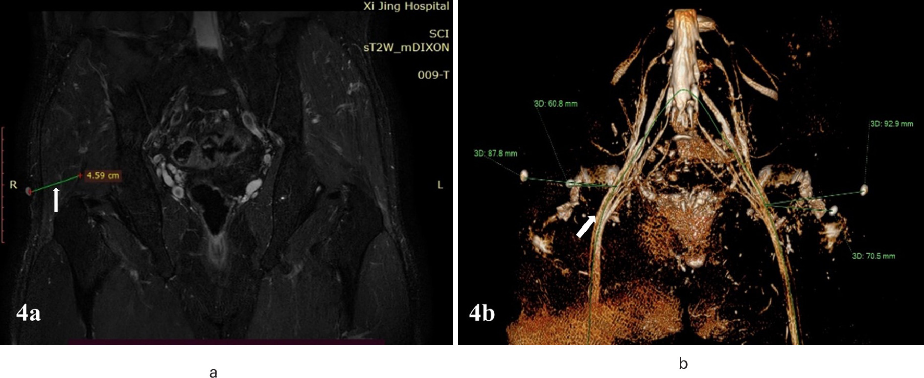 Fig. 4 
            a) In the strong T2-Weighting axial image, the distance from oily capsules to fibrotic contractures was measured. R: oily capsule; arrow: fibrotic contracture. b) The distance from the oily capsule to the sciatic nerve was measured in the 3D images. Arrow: sciatic nerve.
          