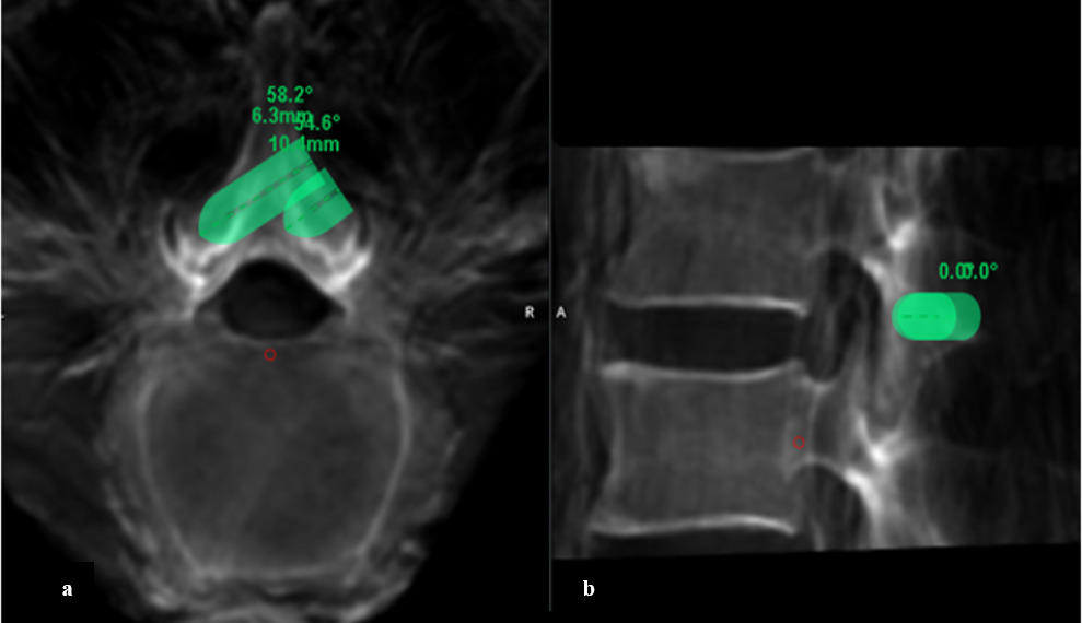 Fig. 1 
            Planning of the bone removal robotic drill for the laminectomy in the cadaver was done on the a) axial and b) sagittal views using two drills with depths of 10 mm and 20 mm, respectively. This allowed for sparing of the ventral laminar cortex and protection of the bilateral facet joints.
          