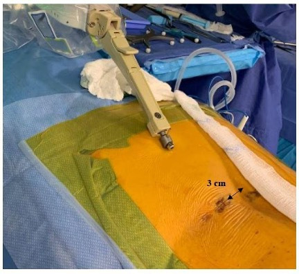 Fig. 2 
            Minimally invasive skin incision incorporating both trajectories at the level of the skin, along the paths predefined by the robot after preoperative surgical planning. Note the plan for a transverse skin incision located 3 cm lateral to the midline (unilateral, modified Wilste approach).
          