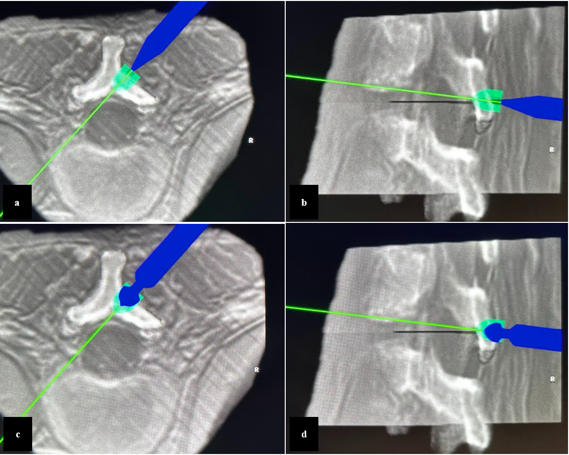 Fig. 3 
            After reaching the lamina, a navigated probe was used to confirm correct bony localization along the predefined drill in both the a) axial and b) sagittal planes. The bone removal robotic drill was inserted and drilled along the predefined trajectory in both the c) axial and d) sagittal views.
          