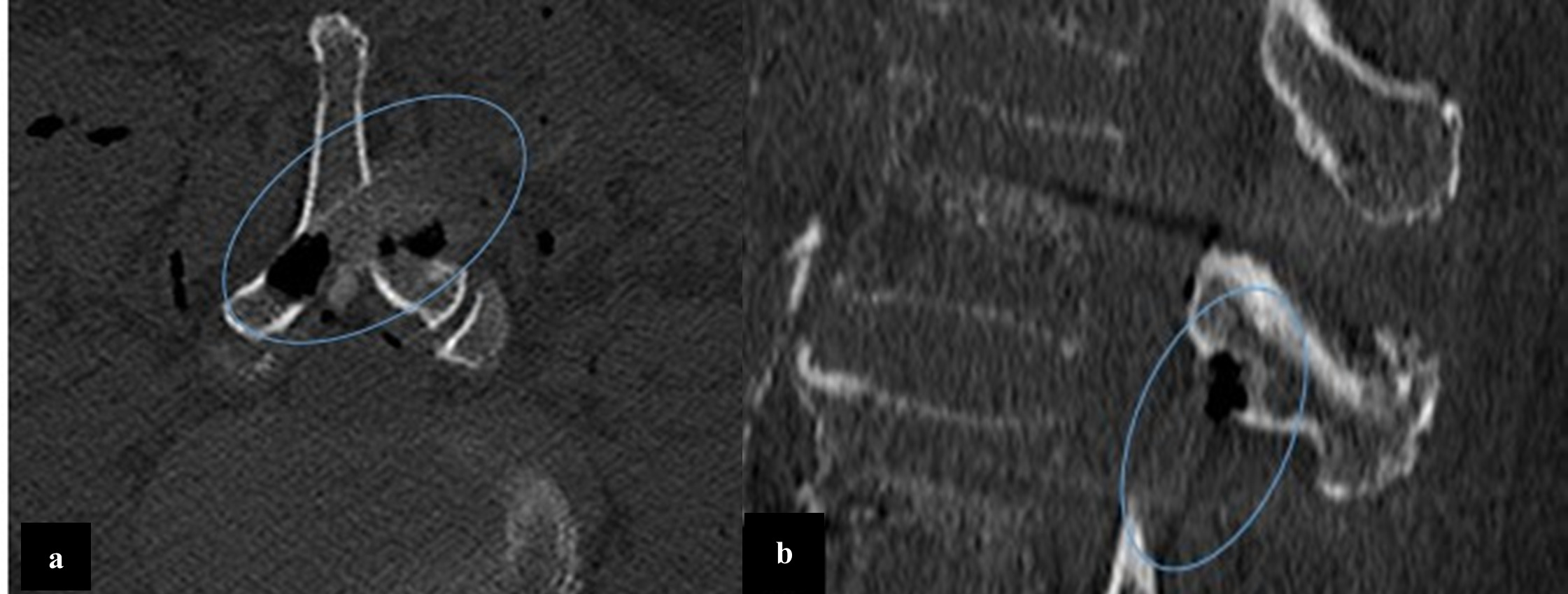 Fig. 4 
            Postoperative CT scan a) axial and b) sagittal views highlighting the extent of the laminectomy defect created by the robotic drill, with sparing of the ventral cortex evident.
          