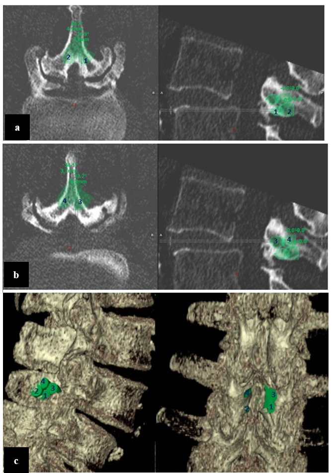 Fig. 6 
            The laminectomy planning process required four different drill paths, all 7.5 mm in diameter and 8 mm (1), 15 mm (2), 10 mm (3), and 15 mm (4) in depth. Two drill paths (1 and 2, image a) were planned more inferior (caudal) on the lamina in the sagittal plane than the other two (3 and 4, image b), which were planned more superior (cranial) on the lamina. In the caudal aspect of the lamina (1 and 2), the presence of the flavum provides a protective anatomical buffer, allowing a more aggressive approach with the drill when approaching the ventral laminar cortex. c) A 3D reconstruction of the planned drill trajectories is represented in posterolateral and posterior views.
          