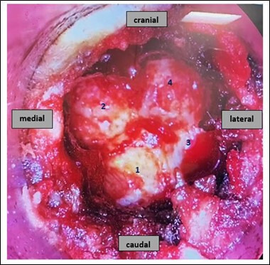 Fig. 7 
            To monitor the extent of the decompression of the lamina, an endoscopic viewing portal was used, showing the four drills created with the bone removal robotic drill.
          