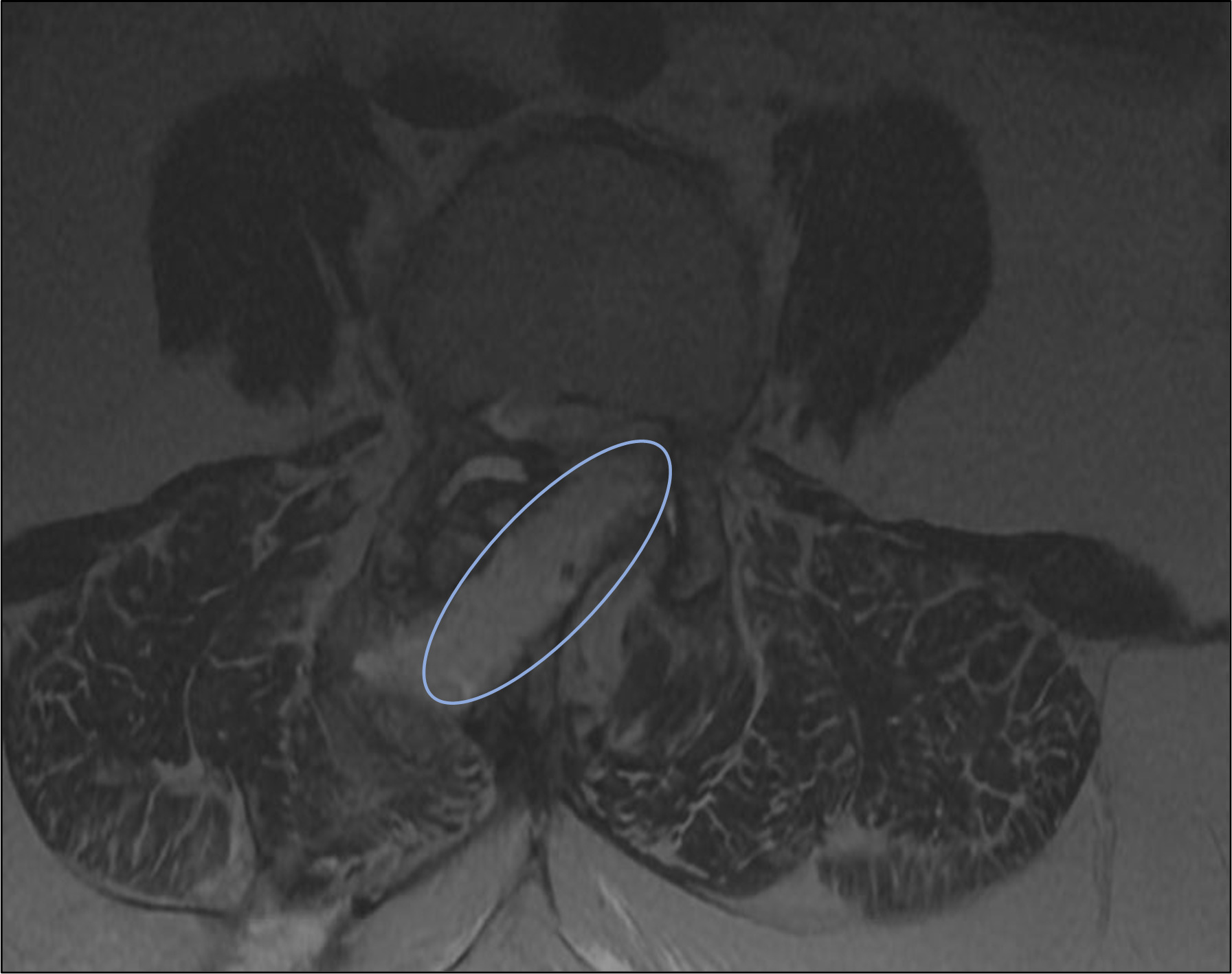 Fig. 8 
            Axial postoperative spoiled gradient echo (SPGR)-MRI at three weeks’ follow-up. This image highlights the trajectories of the decompression made with the bone removal robotic drill. Notably, additional manual decompression with a navigated burr and a Kerrison rongeur was performed, as described.
          