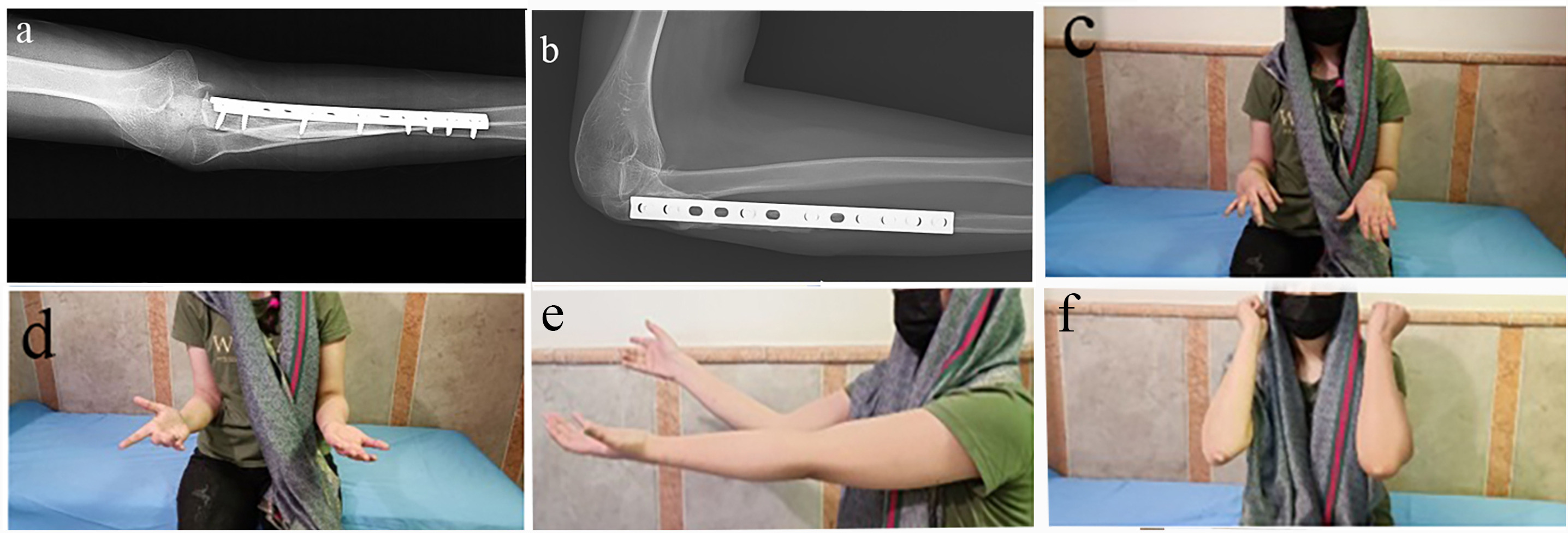 Fig. 3 
            a) and b) Anteroposterior and lateral radiographs of the elbow in a 12-year-old female patient showing union at the junction of the allograft and host bone four years after the resection of proximal ulna telangiectatic osteosarcoma and osteoarticular allograft reconstruction. c) to f) Clinical photographs of the same patient showing the elbow range of motion.
          