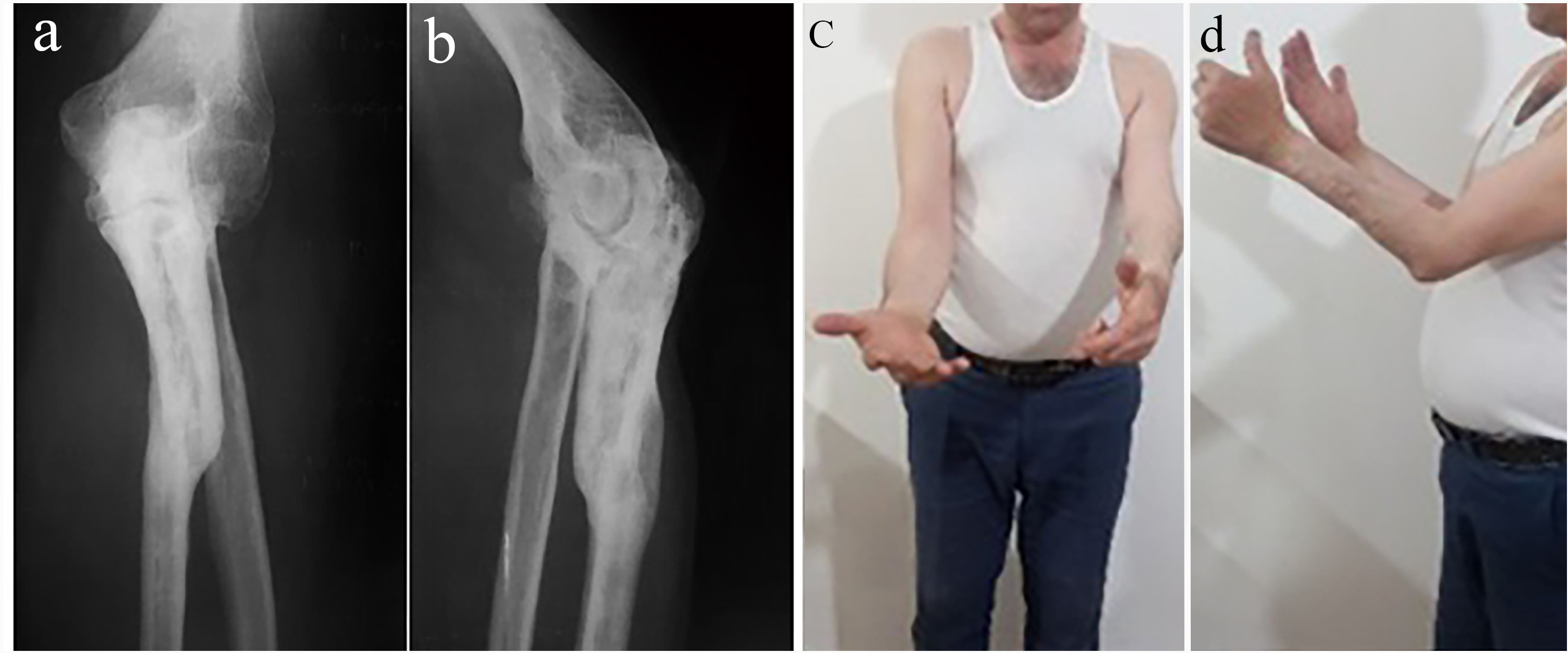 Fig. 4 
            a) and b) Nine-year follow-up radiographs of a 23-year-old male showing severe degenerative joint disease at the left elbow joint causing limited flexion and supination (c and d), finally requiring elbow joint fusion.
          