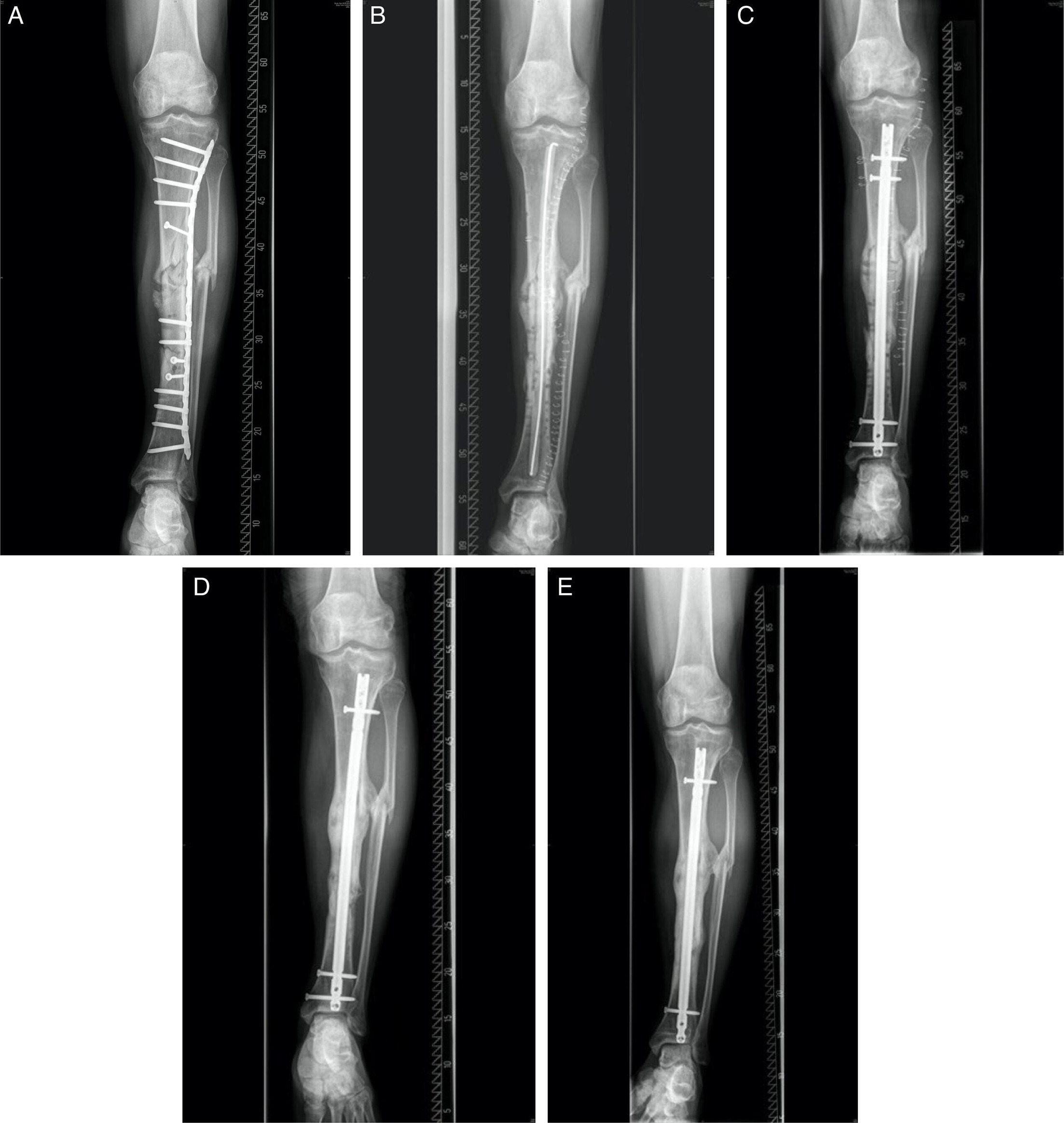 Fig. 2 
            Radiological example for nonunion treatment under application of the diamond concept in our department with osseus consolidation. a) Radiological imaging (anteroposterior) before a nonunion treatment of an infected diaphyseal tibia nonunion (defect size ~13 cm) of a 60-year-old male patient. b) First surgical treatment occurred via Masquelet stage 1 with removal of previous implanted material, radical debridement, and implantation of a local and intramedullary antibiotic-laced polymethylmethacrylate (PMMA) spacer. c) After reaching clean septic status, Masquelet stage 2 was performed, removing the spacer and filling the induced membrane with autologous bone using reamer irrigator aspiration technique under further addition of Vitoss and implantation of a tibia nail, creating stability. d) At one-year follow-up, after dynamization of the nail, full osseus consolidation was achieved (Lane-Sandhu score 4). e) At two-years follow-up, further bone remodelling had occurred.
          