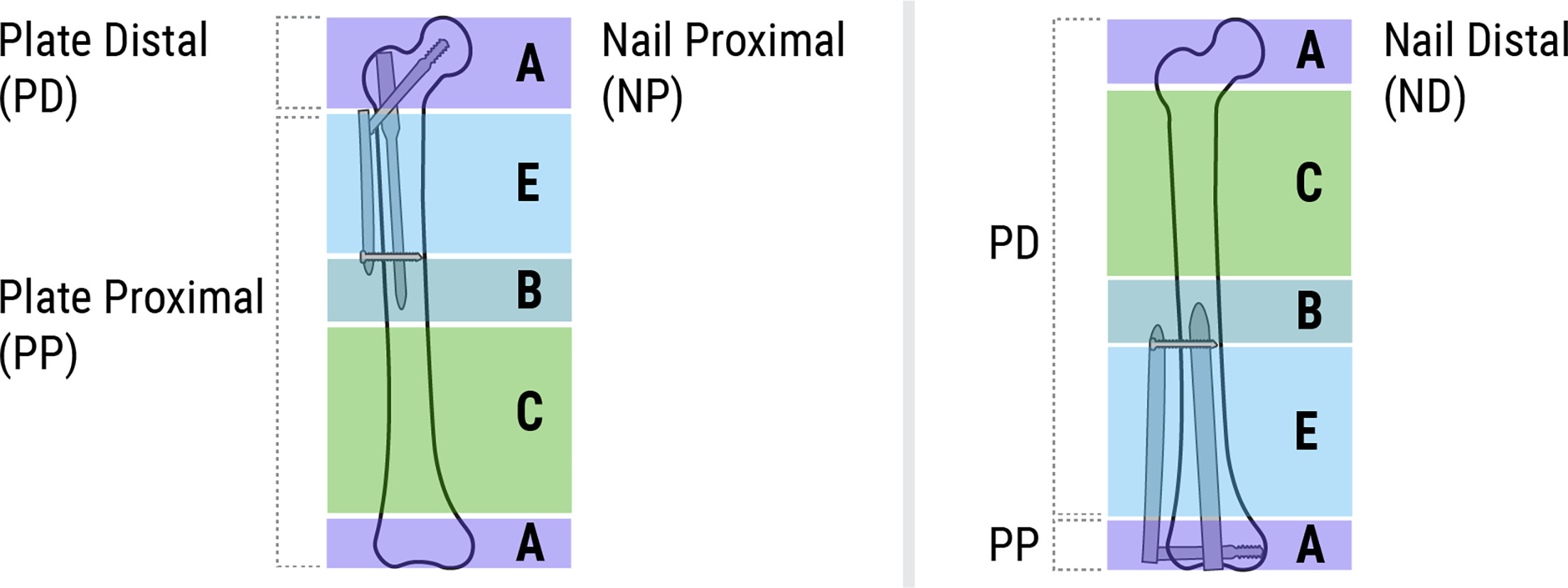 Fig. 1 
          Diagram demonstrating the Broggi classification system for femoral peri-implant fractures, excluding type D fractures.
        