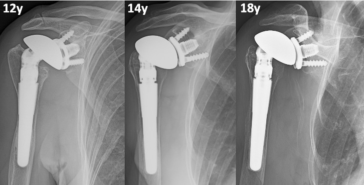 Fig. 8 
            Anteroposterior radiograph views of a 61-year-old female patient with progressive wear of the polyethylene (PE) with reduced thickness between the components. At last follow-up, mild upward migration of the humeral head is observed with complete wear in the superior part of the PE.
          