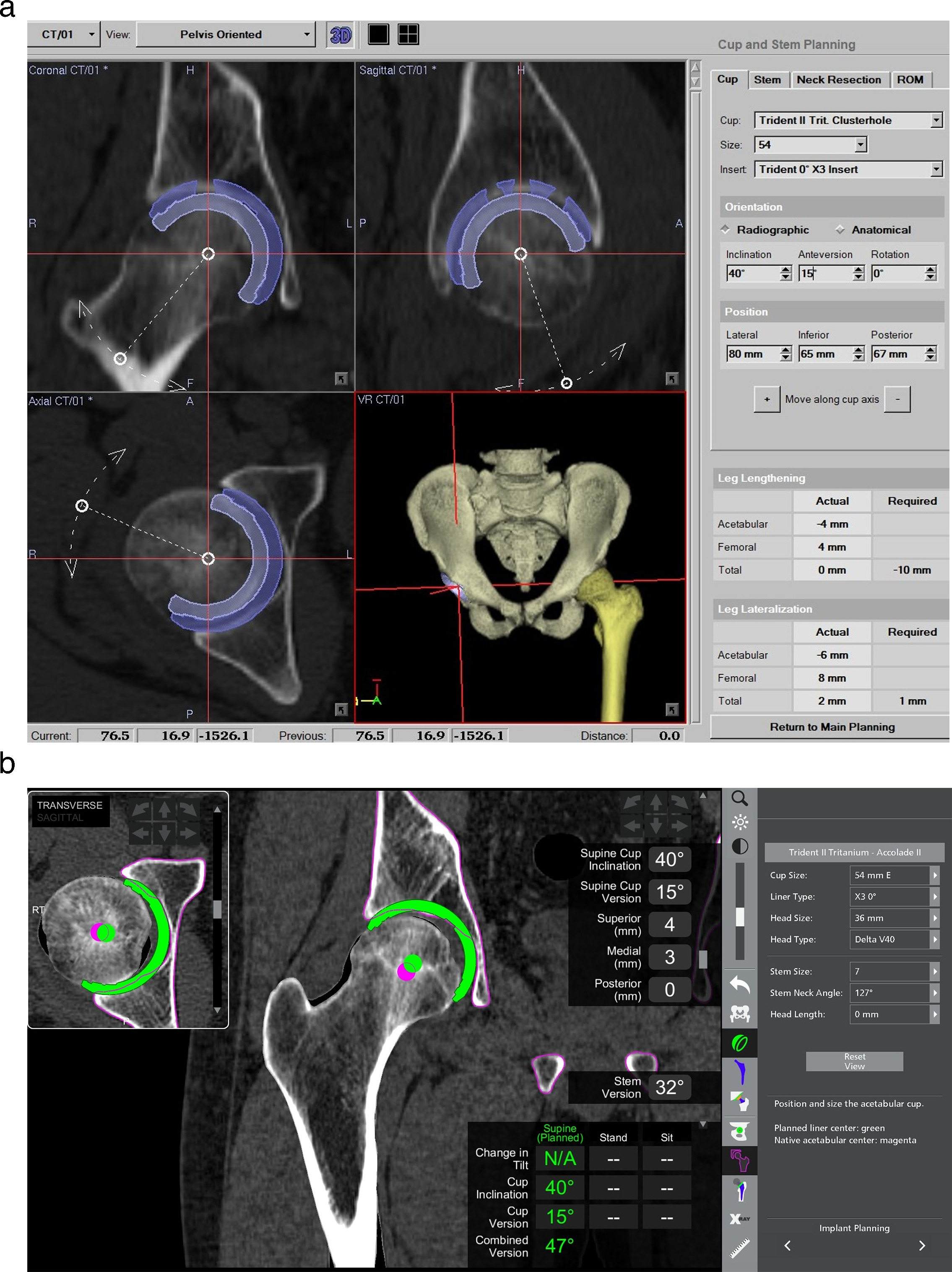 Fig. 1 
            Preoperative planning was performed with a) a CT-based hip navigation system (Stryker CT-Hip System v. 1.1; Stryker, Germany), and then b) the data were accurately transferred to the Mako Total Hip application (Stryker, USA).
          