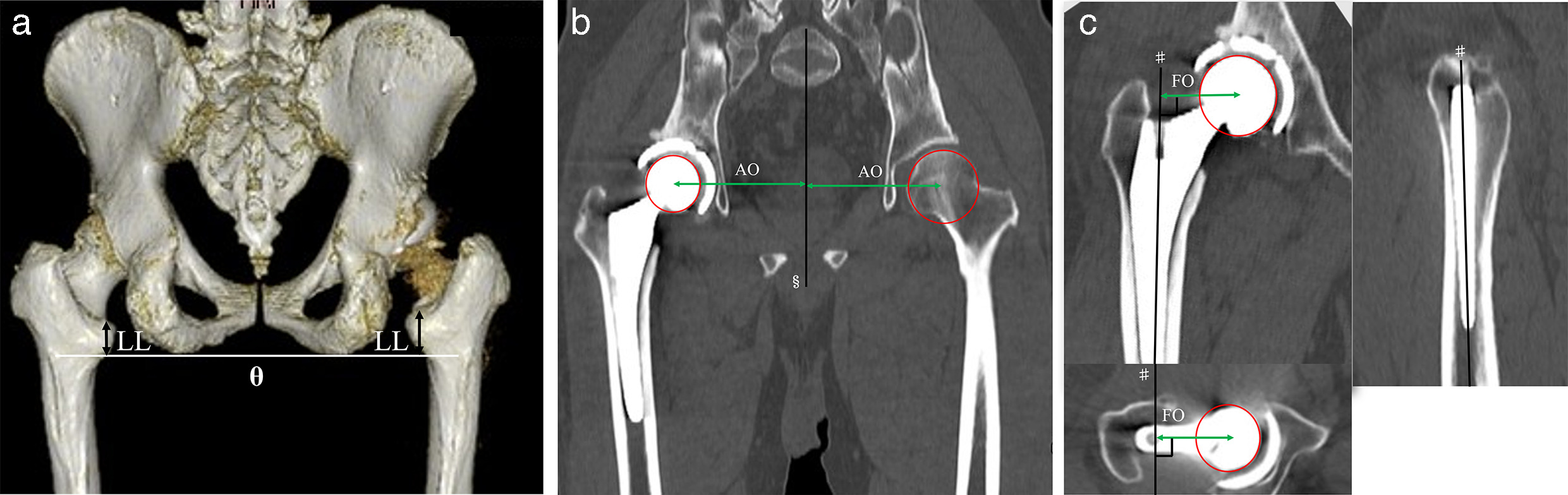 Fig. 2 
            a) Pre- and postoperative leg length (LL), b) postoperative acetabular offset (AO) and femoral offset (FO), and c) global offset (AO + FO). Discrepancies were investigated using 3D image processing workstation (Ziostation 2; Ziosoft, Japan). θ: the line passing through bilateral distal ends of ischial tuberosities. §: the line passing through the centre of the first sacral vertebral body and the midpoint of bilateral pubic tubercles. ♯: the axis of the femoral canal.
          