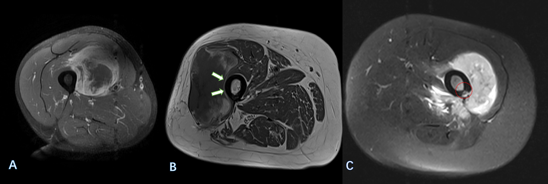 Fig. 2 
            Transverse section of MRI of soft-tissue sarcoma (STS) abutting the adjacent cortical bone. a) Tumour extending to the adjacent cortical bone without soft-tissue interface. This lesion had an approximately 33% circumferential abutment of the femur. b) A thin layer of normal soft-tissue (arrows) separates the tumour from the adjacent bone. No cortical contact was considered in this case. c) The circled area shows signal change in both the cortex and the medullary cavity, indicating STS with frank cortex destruction and medullary canal invasion.
          