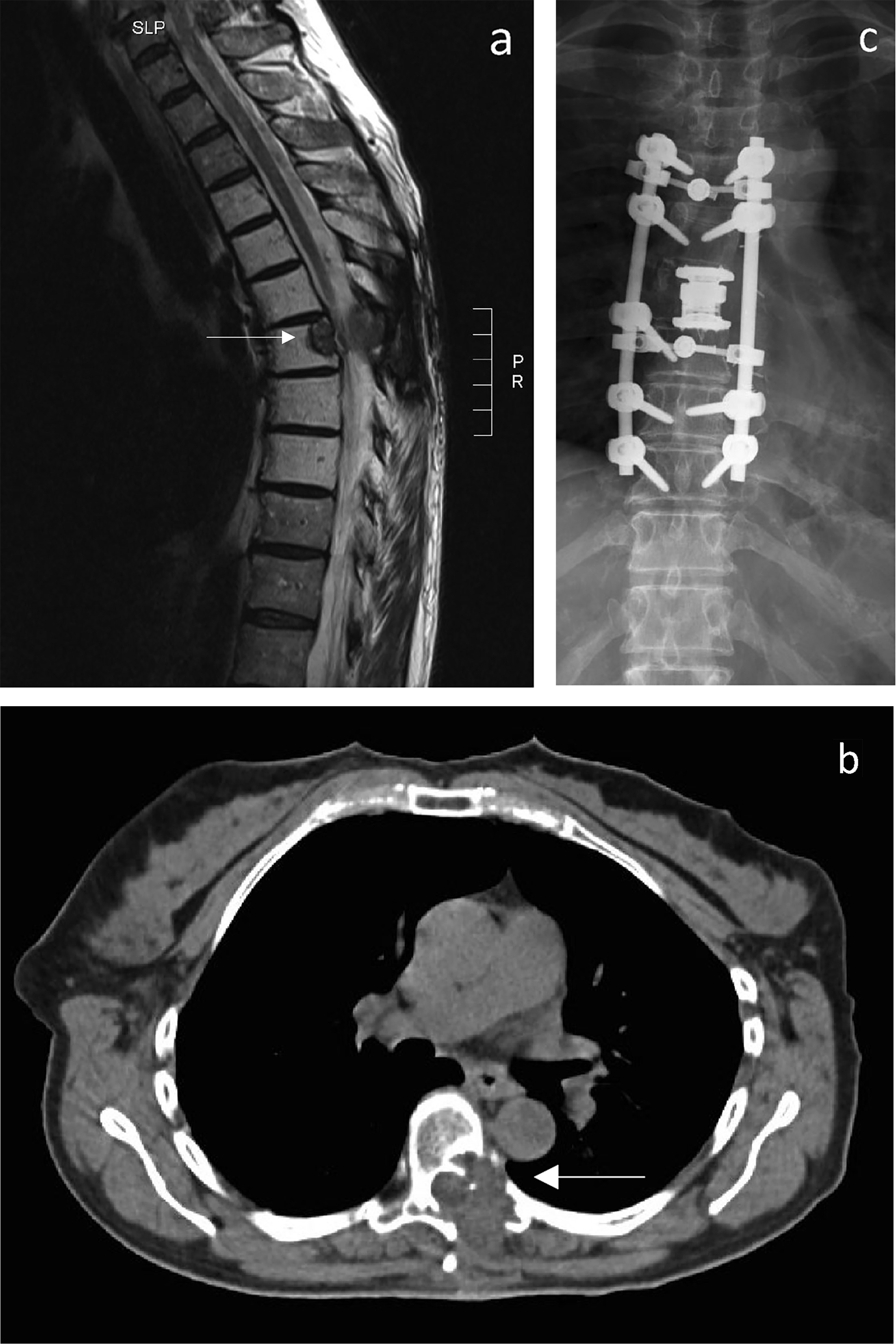 Fig. 5 
            A 63-year old female patient experiencing pain for one month, with inconclusive biopsy of the lesion in the seventh thoracic vertebral body, as shown by a) sagittal and b) axial MRI at time of diagnosis. Intralesional tumour resection and hemilaminectomy Th7 using a single-staged posterior approach and postoperative radiotherapy were performed; histology revealed leiomyosarcoma G1. Local recurrence in Th7 infiltrating the adjacent rib occurred four years later. Costotransversectomy Th6 and Th7 and hemivertebrectomy Th7 followed by dorsal stabilization Th5 to 10 was performed (postoperative plain radiographs in c) anteroposterior view). Eight years later, a single metastatic lesion in the sacrum was detected and addressed by curettage. At latest follow-up, no evidence of disease could be found.
          