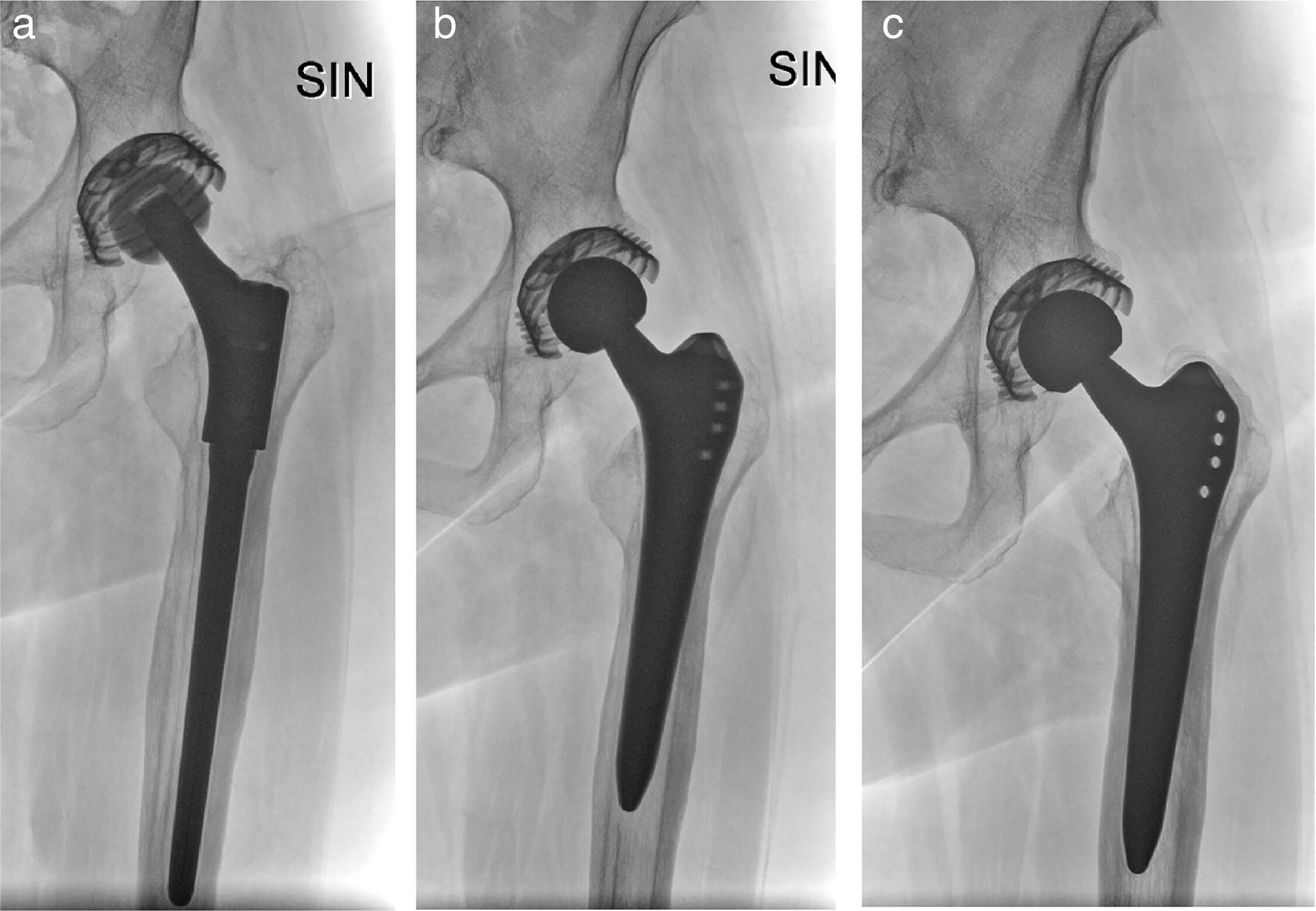 Fig. 5 
          a) Preoperative anteroposterior (AP) radiograph of a 57-year-old female with aseptic loosening of modular revision stem three years after surgery. b) Postoperative AP radiograph of stem revision from a modular revision stem to a primary Zweymüller stem. c) Follow-up AP radiograph at seven-year follow-up showing osseointegration and stable implants.
        