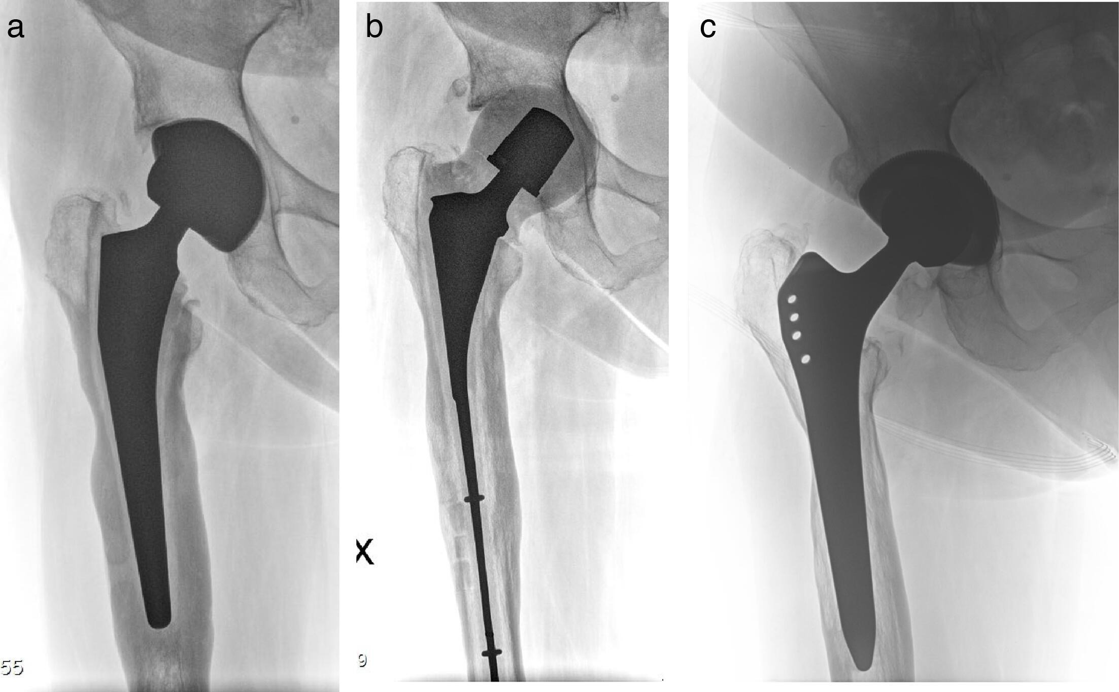 Fig. 6 
          a) Preoperative anteroposterior (AP) radiograph of a 72-year-old female with infected total hip arthroplasty with gross stem loosening. b) Postoperative AP radiograph showing implant removal through a cortical window and implantation of a custom-made spacer. c) Seven-year follow-up AP radiograph after staged revision to a Zweymüller stem showing osseointegration and stable implants.
        