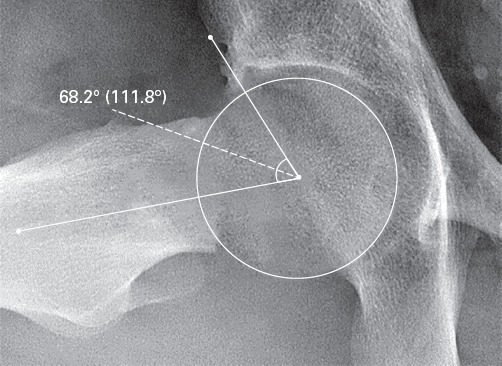 Fig. 1 
            Radiograph showing an example of alpha measurement on Dunn lateral imaging.
          