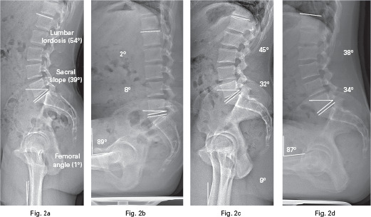 Fig. 2 
            Radiographs showing sacral slope, proximal femoral angle, and lumbar lordosis measurements for: a 24-year-old male patient without femoroacetabular impingement (non-FAI) a) standing and b) sitting (52° spine flexion, 57° femoroacetabular flexion); and a 33-year-old male patient with symptomatic FAI c) standing and d) sitting (7° spine flexion, 80° femoroacetabular flexion).
          