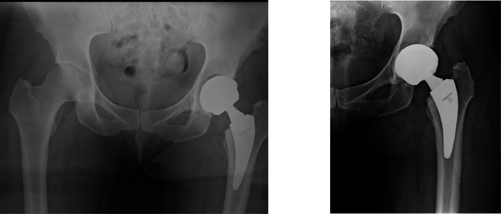 Fig. 4a - 4b 
          Postoperative radiographs of a 52 year-old female patient demonstrating a component that a) was not adequately impacted, b) leading to loss of position at one week postoperatively.
        