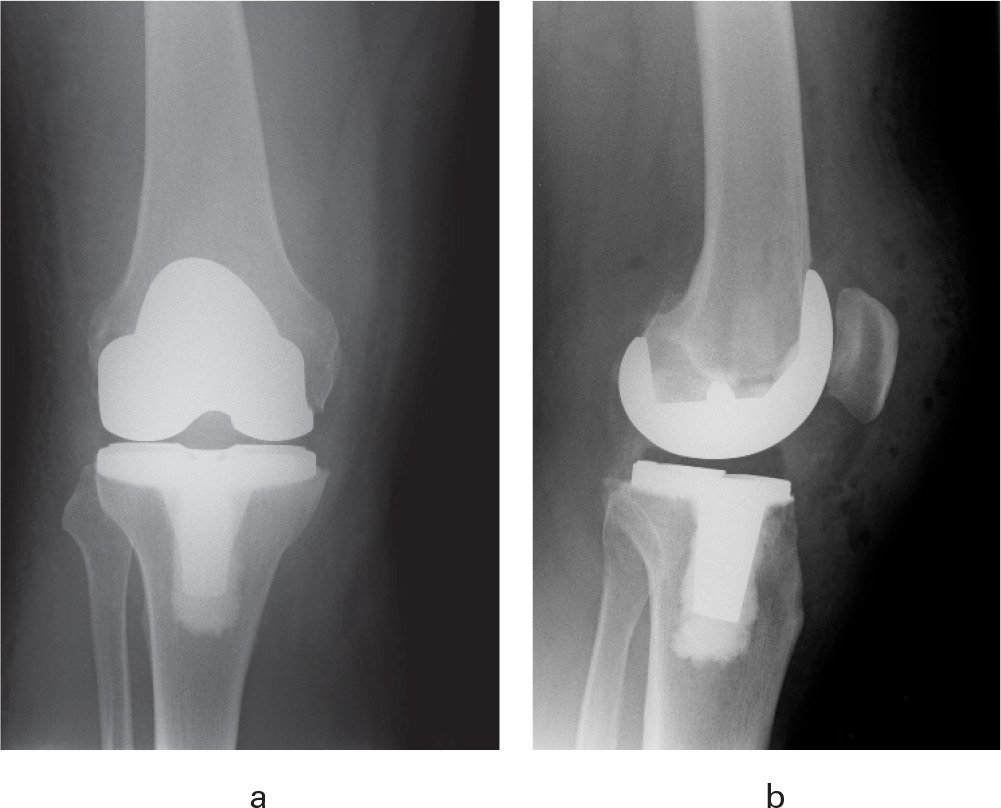Fig. 2 
          a) Anteroposterior and b) lateral postoperative radiographs showing a NexGen LPS-Flex total knee arthroplasty.
        