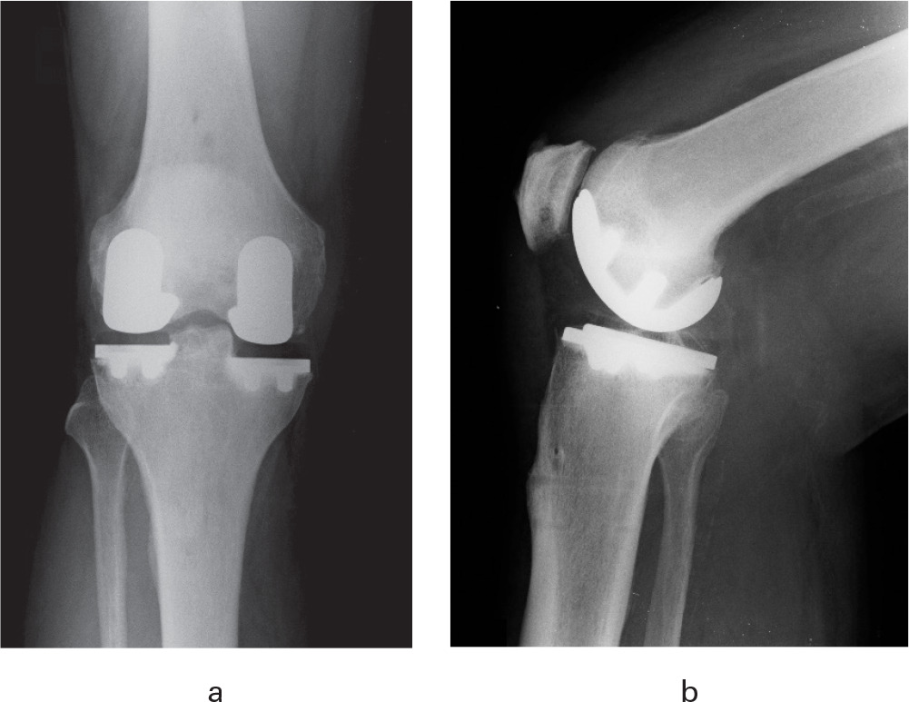 Fig. 3 
          a) Anteroposterior and b) lateral postoperative radiographs showing a bi-unicompartmental knee arthroplasty with medial and lateral Restoris MCK implants.
        