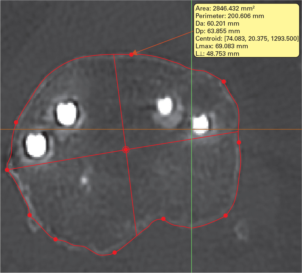 Fig. 5 
          Example of measurement on axial CT, using Mimics software (Materialise NV, Leuven, Belgium), of the centre of the tibia following bi-unicompartmental knee arthroplasty.
        