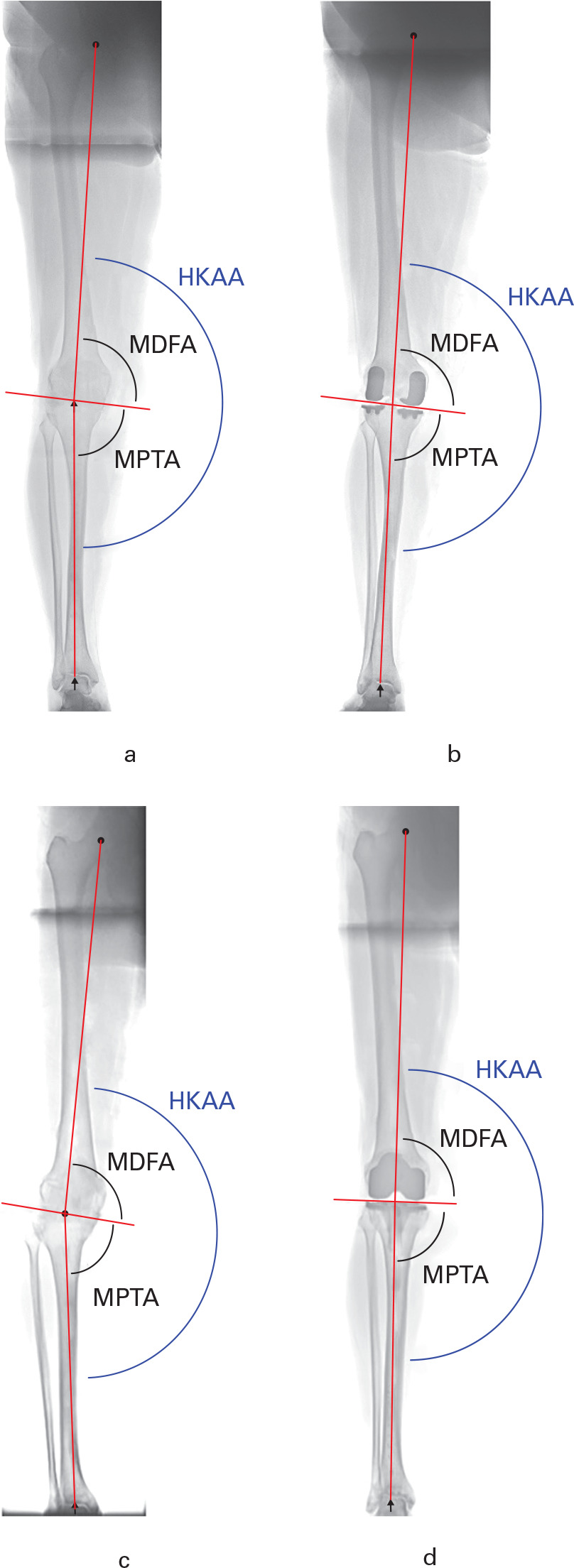 Fig. 6 
          a) Pre- and b) postoperative long-leg standing radiographs showing correction of hip-knee-ankle angle (HKAA), while the obliquity of the joint line is maintained, following bi-unicompartmental knee arthroplasty. c) Pre- and d) postoperative long-leg standing radiographs showing correction of HKAA and alteration of the obliquity of the joint line following total knee arthroplasty.
        