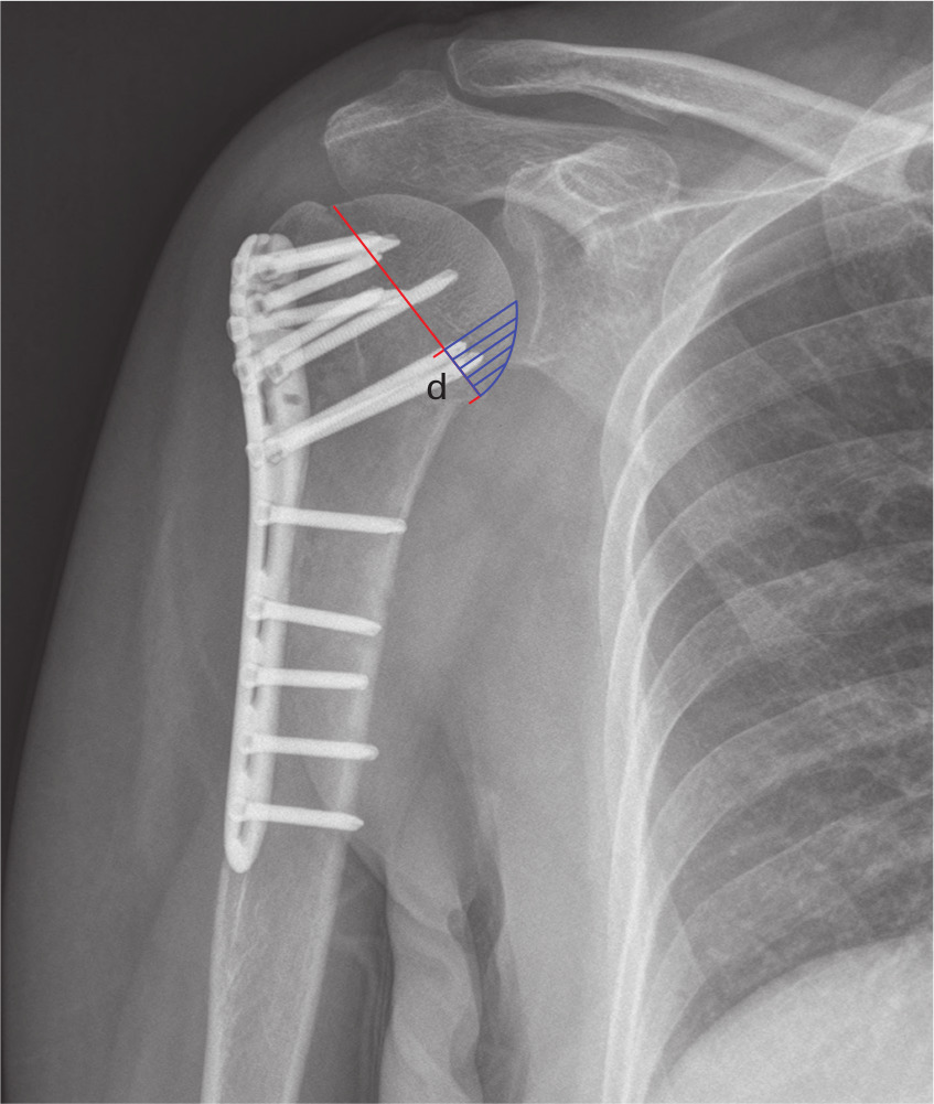 Fig. 3 
          The dashed area shows the optimal position of calcar screws. The length of the side 'd' equals 25% of the border of the articular surface.
        