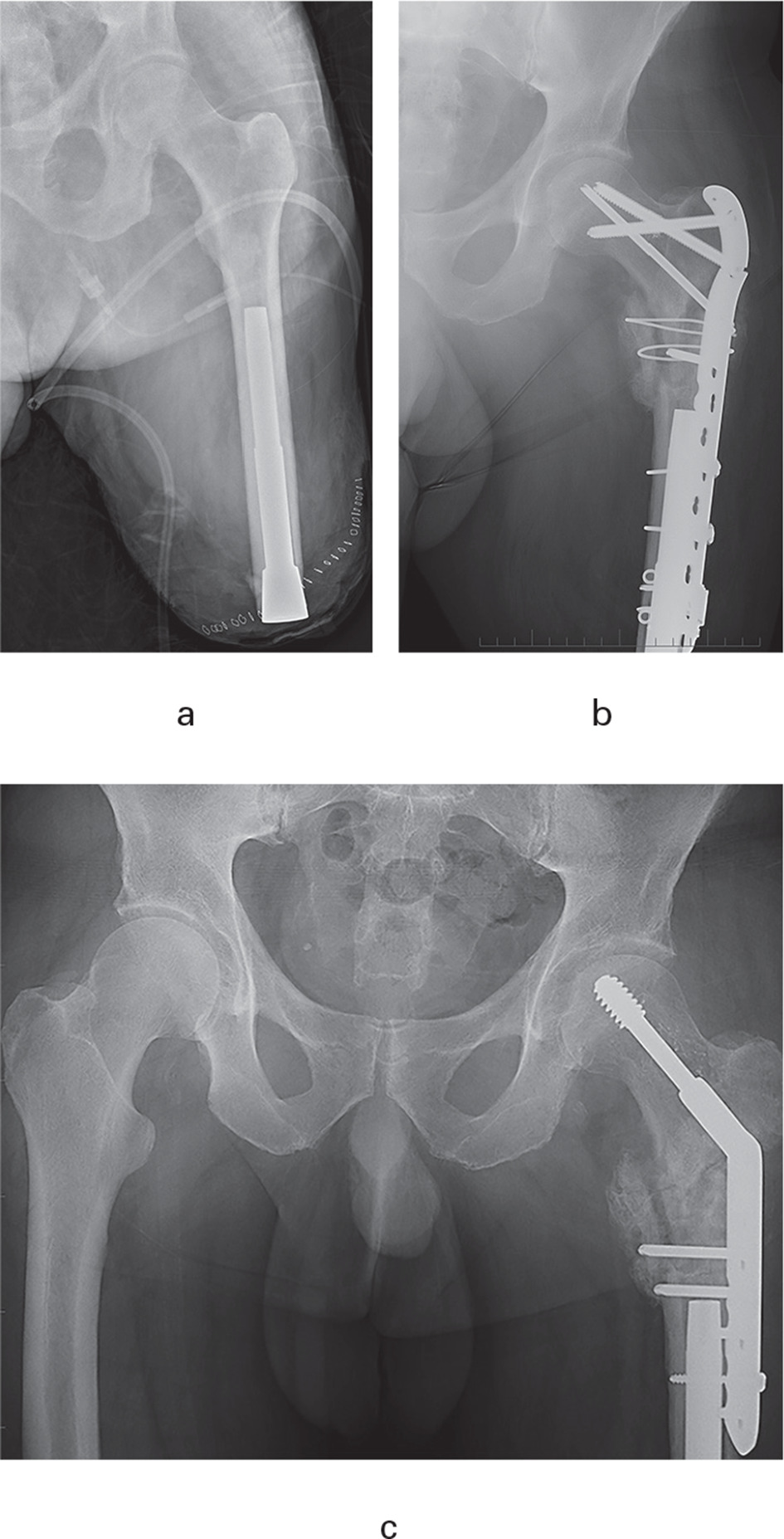 Fig. 4 
          Anteroposterior radiographs of the left hip and femur (a and b) and pelvis (c) of a 62-year-old man with who had left transfemoral amputation due to cancer; a) the immediate postoperative appearance (12 years and one month after amputation); b) he sustained an intertrochanteric fracture three months later due to a fall; a different surgeon used the recommended reconstruction plate but it broke ten months later, possibly due to excessive varus positioning; c) revision was undertaken by the initial surgeon (MAM) using a dynamic hip screw and no further care has been required for three years. His K-level improved from 2 before osseointegration to 3 after the care of his fracture, and his prosthesis wear remained unchanged at ≥ 16 hours/day.
        